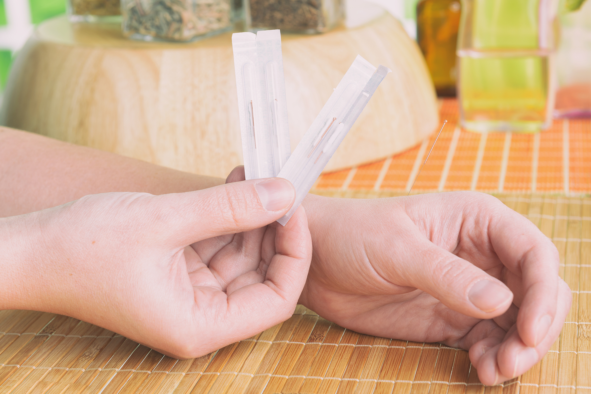 hand applying acupuncture needle