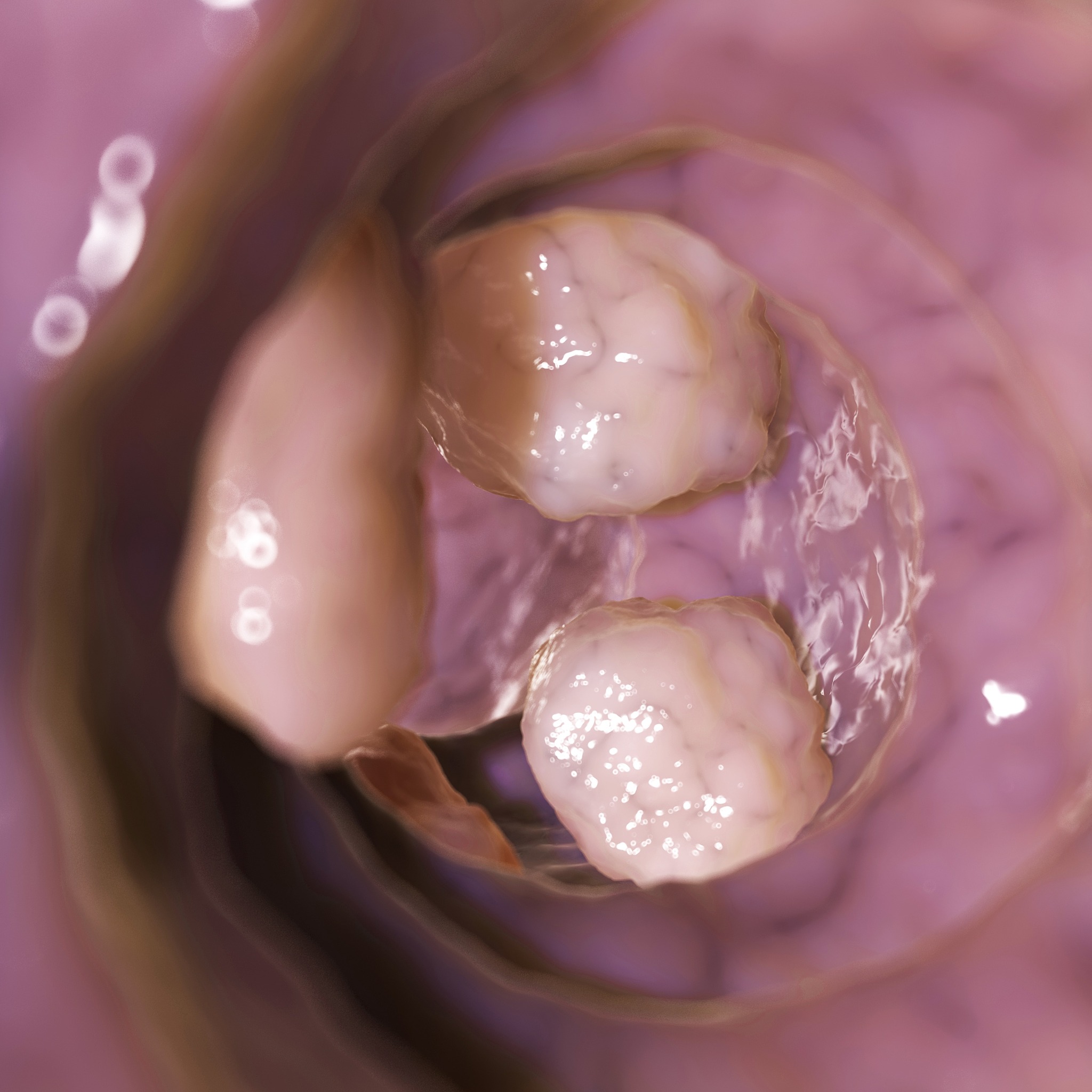 呋喹替尼联合化疗治疗肠癌：有效延长生存期，改善预后