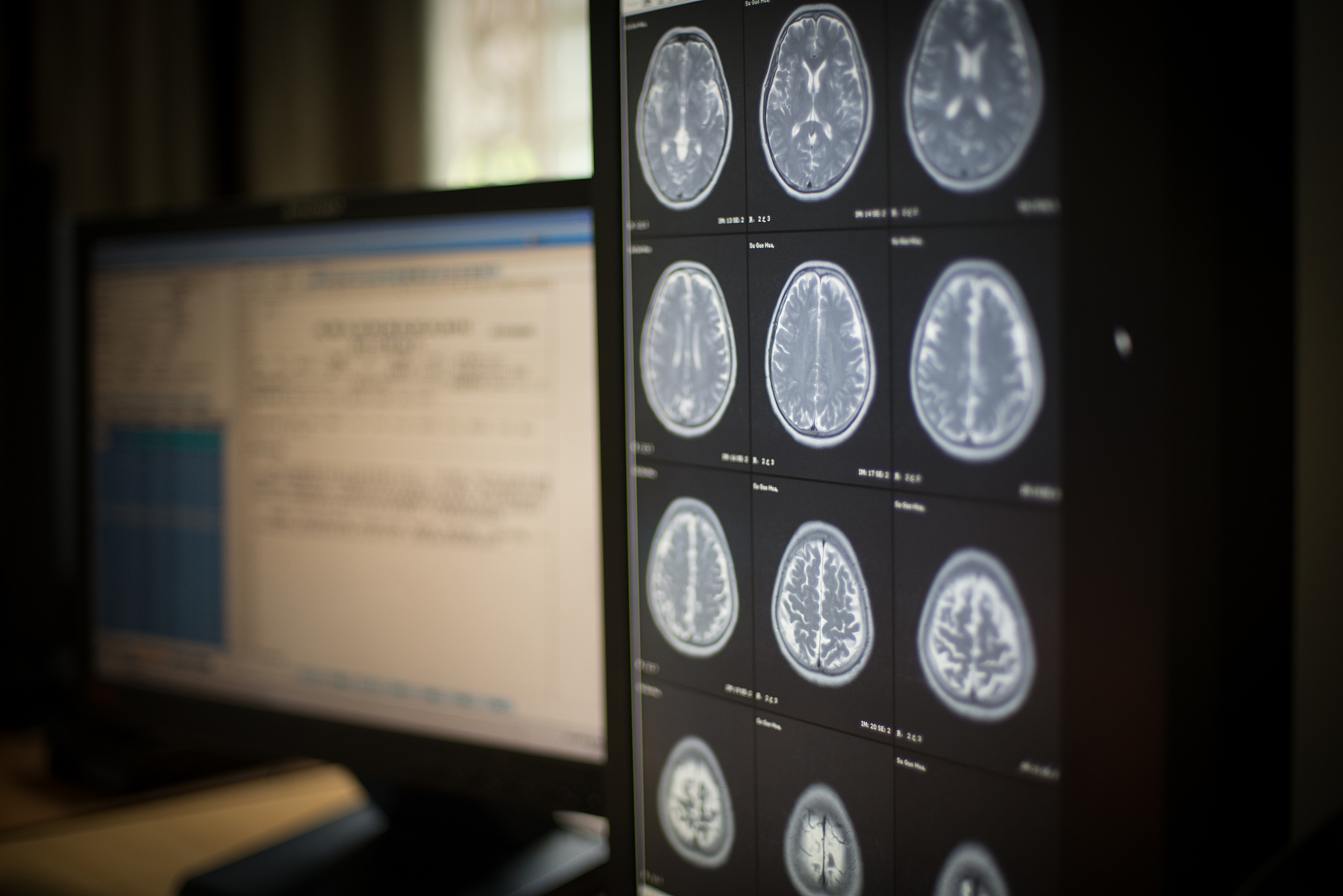 横结肠腺癌的CT增强及病理诊断的优势