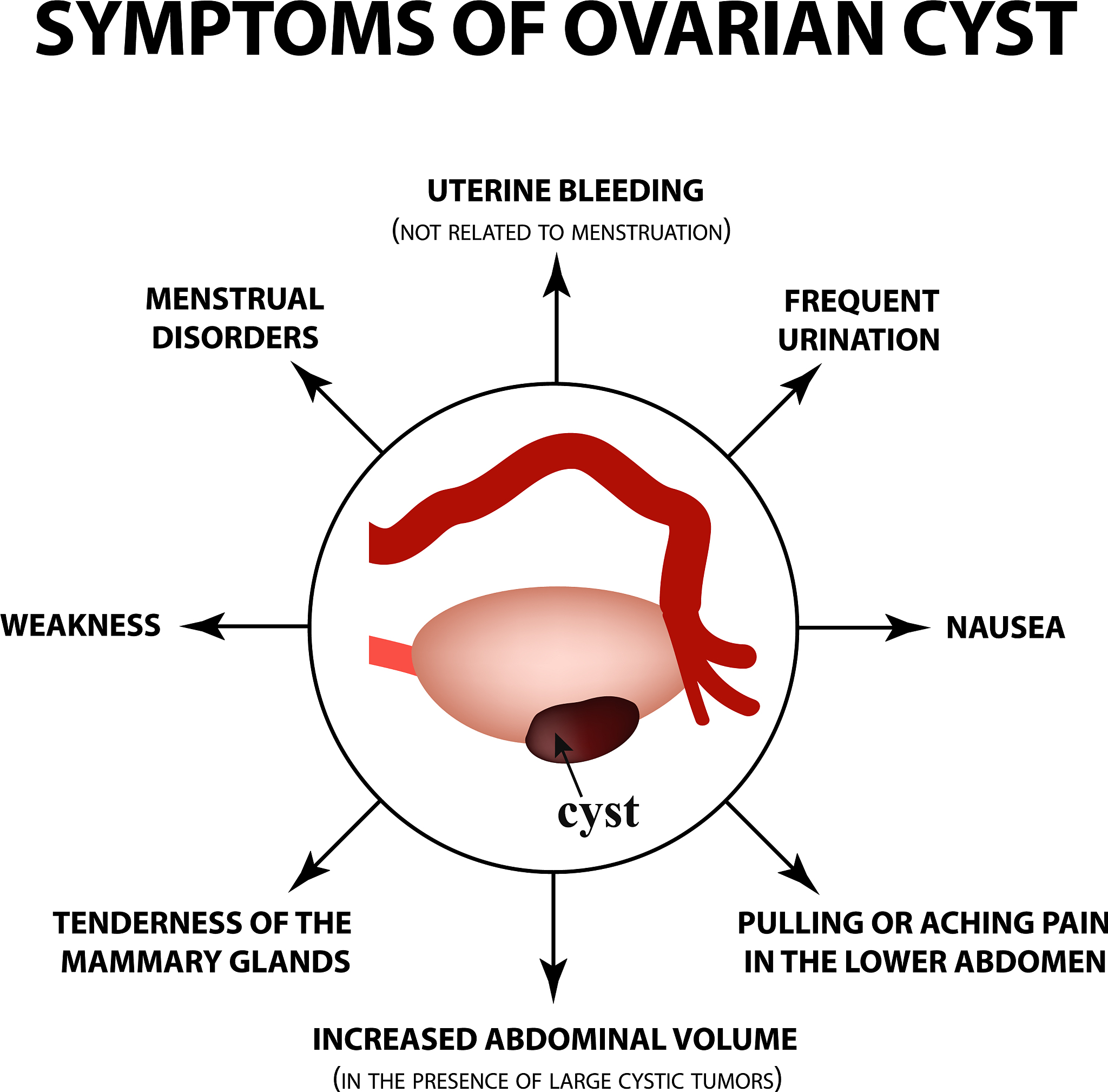 29岁女性下腹痛CT诊断分析：3种可能诊断及鉴别