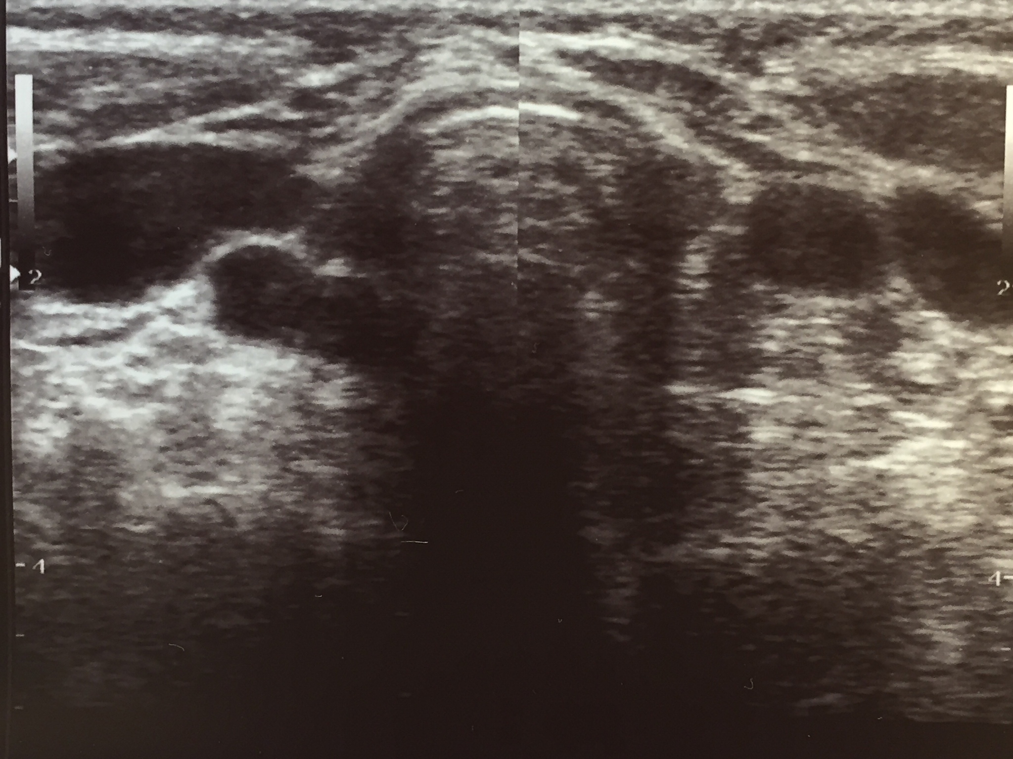 颈动脉搏动与斑块远端运动的潜在联系