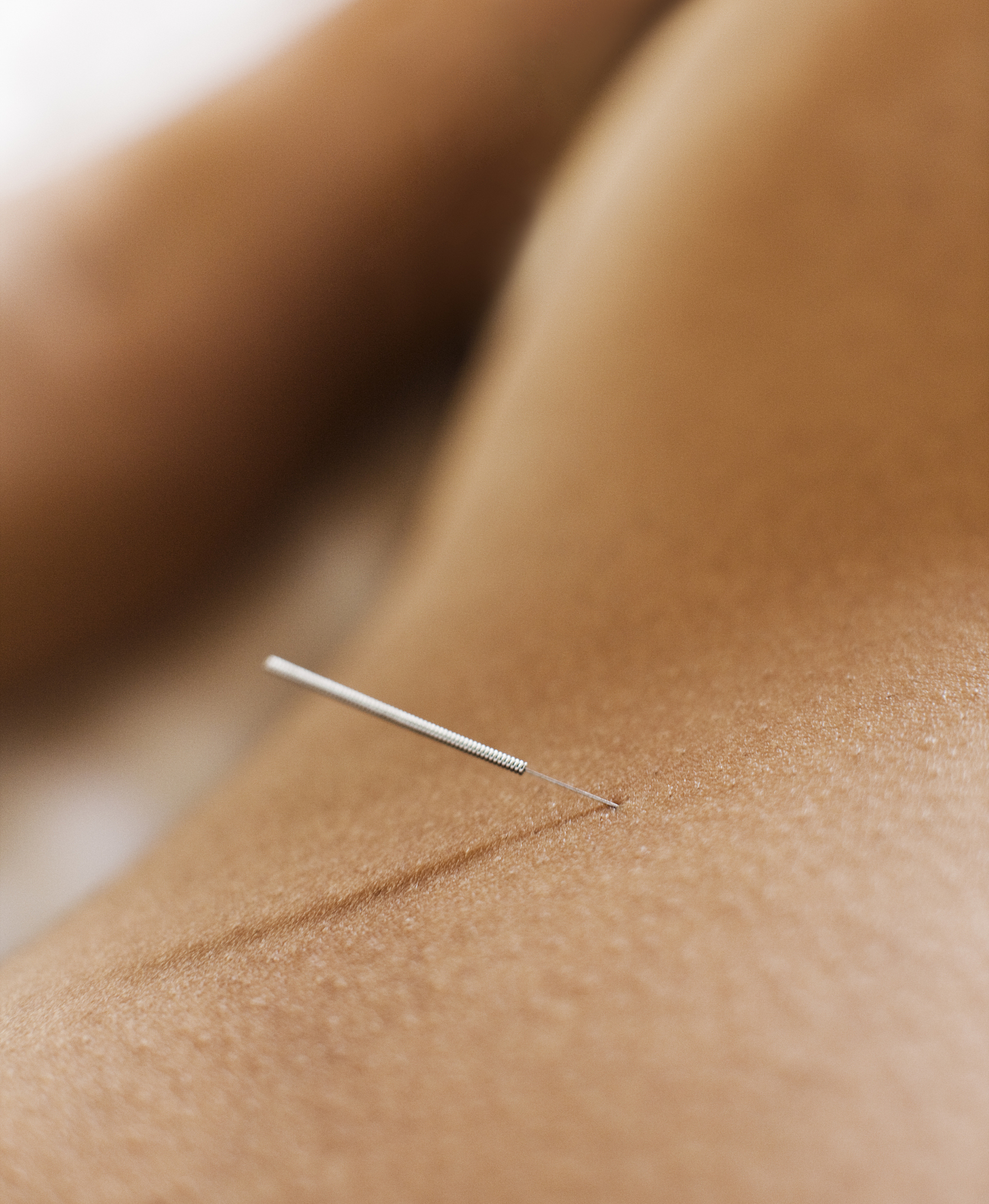 woman receiving accupuncture.