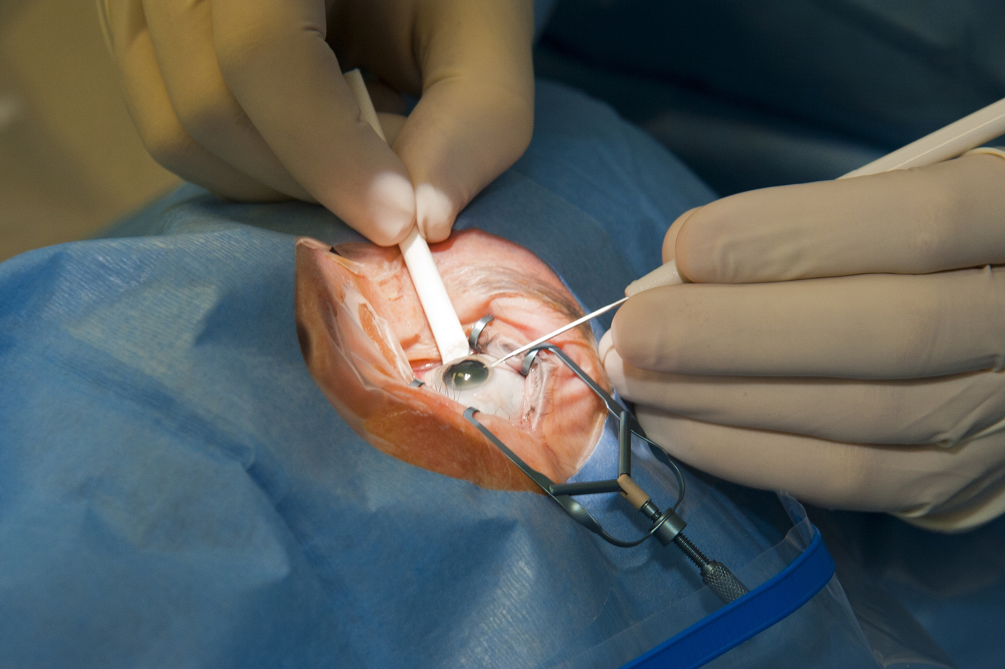 eye surgery