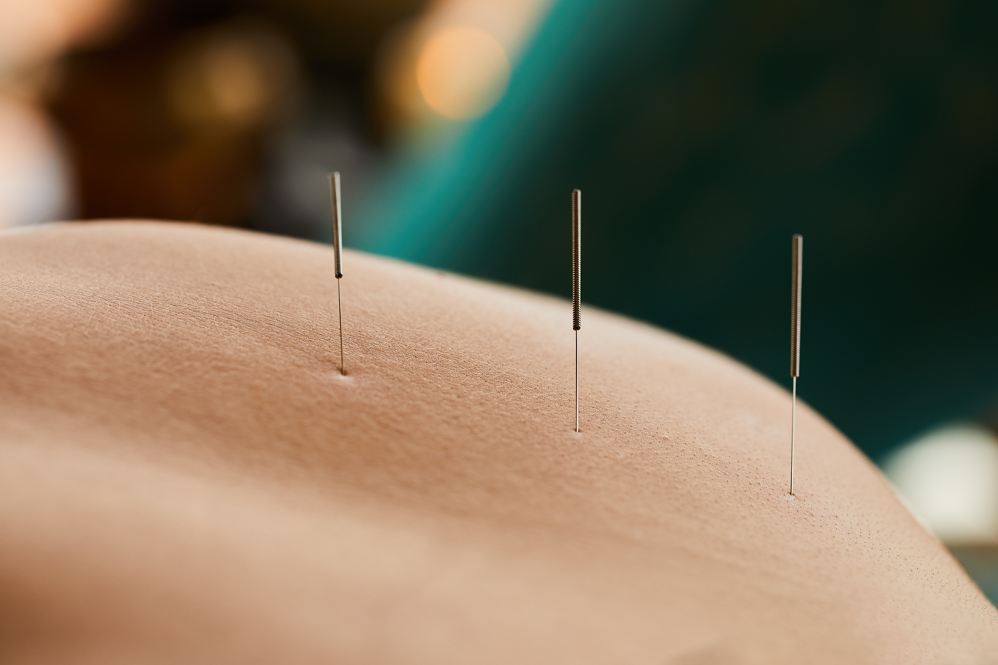 woman having an acupuncture session on her back