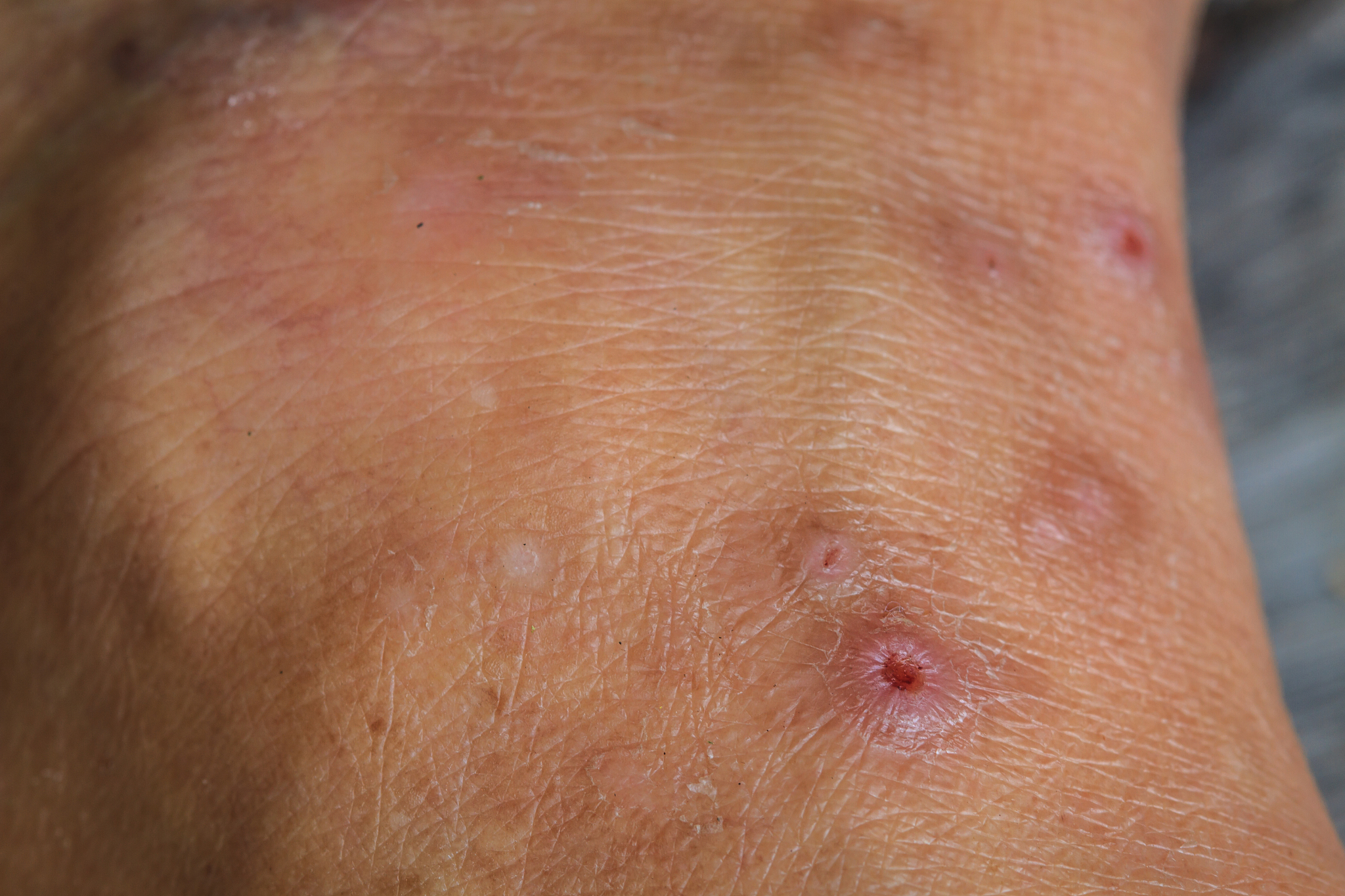 scar on the human skin