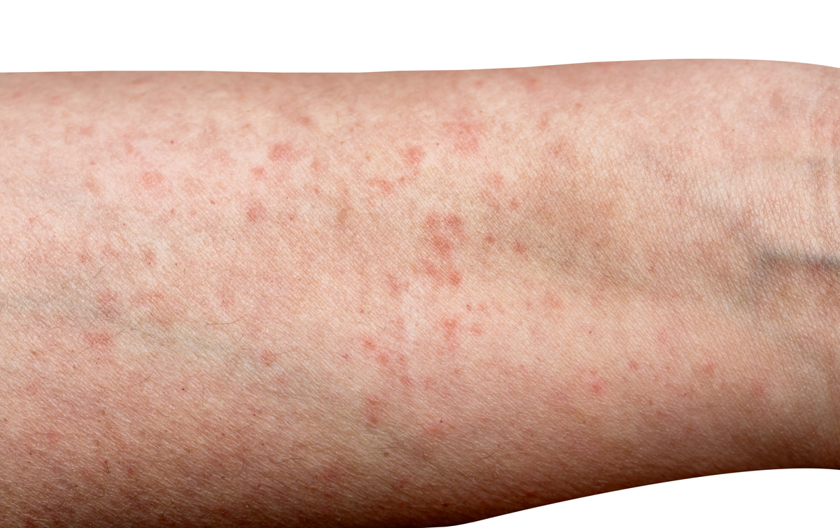 发烧后起疹子：常见原因及处理方法