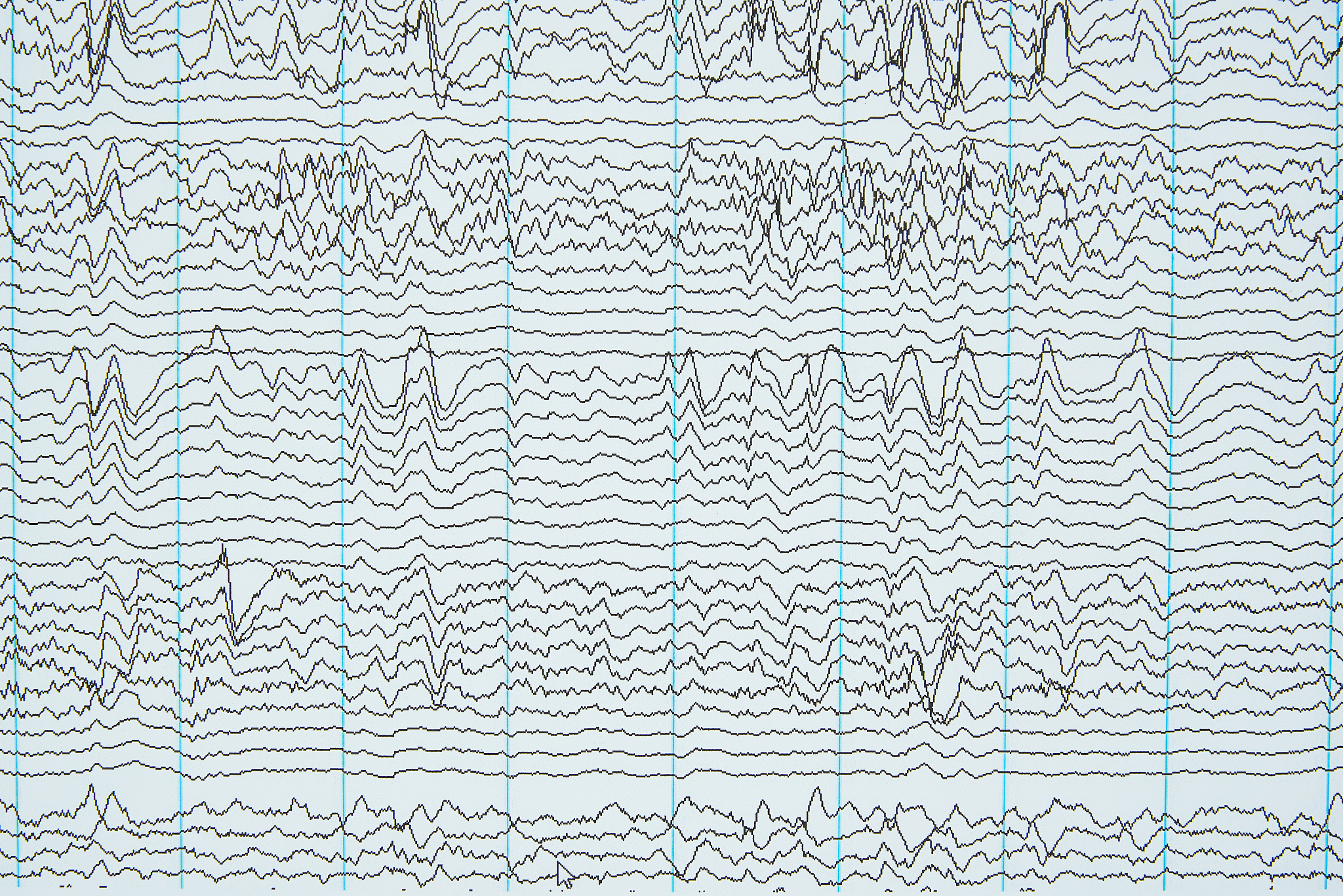 癫痫持续状态患儿安全管理指南：预防、急救与护理