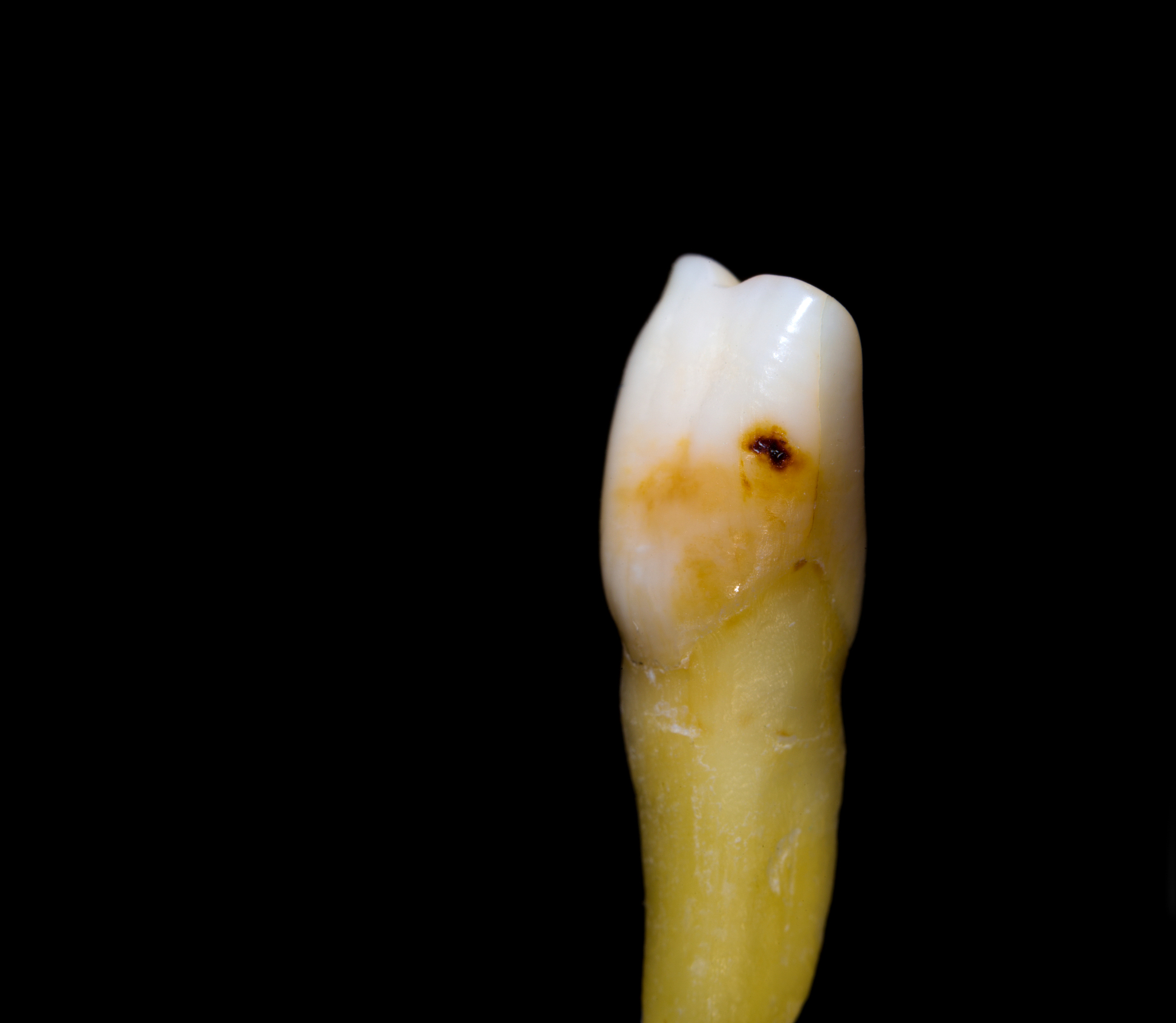 牙齿表明有黑色裂痕是不是蛀牙了？