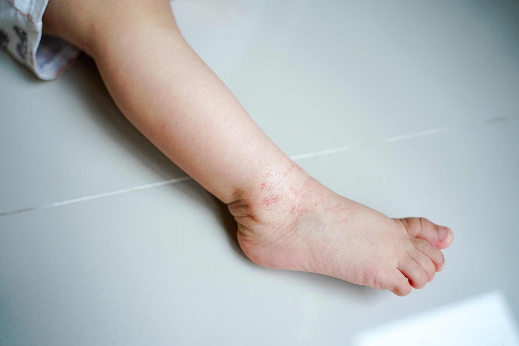 婴幼儿湿疹如何护理？用比较口语化的方式回答