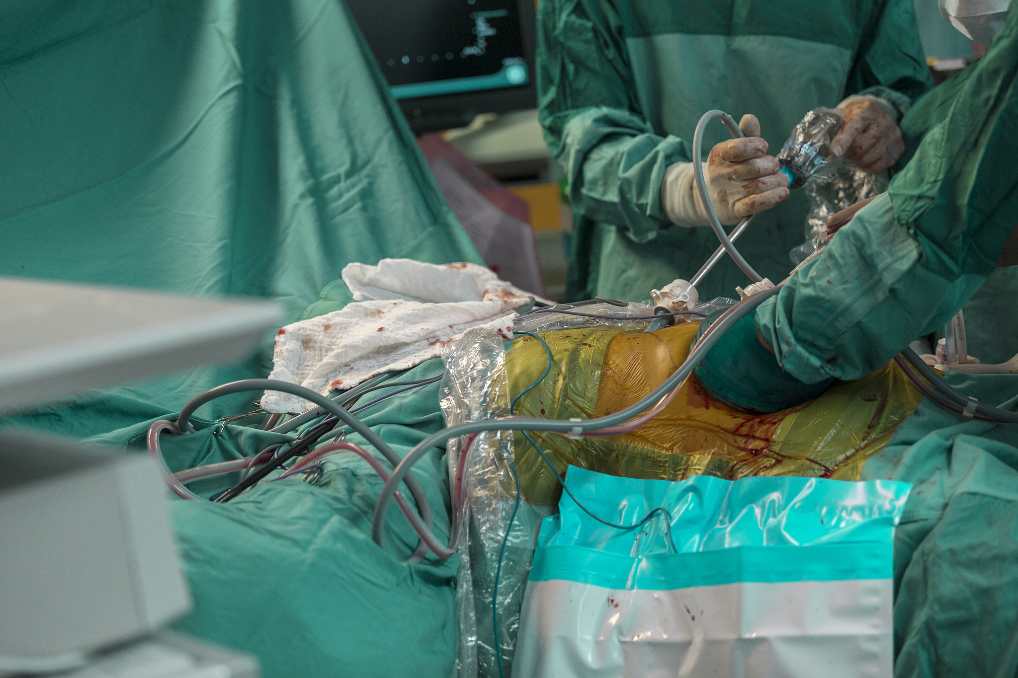 laparoscopic surgery.surgeons operating with laparoscope
