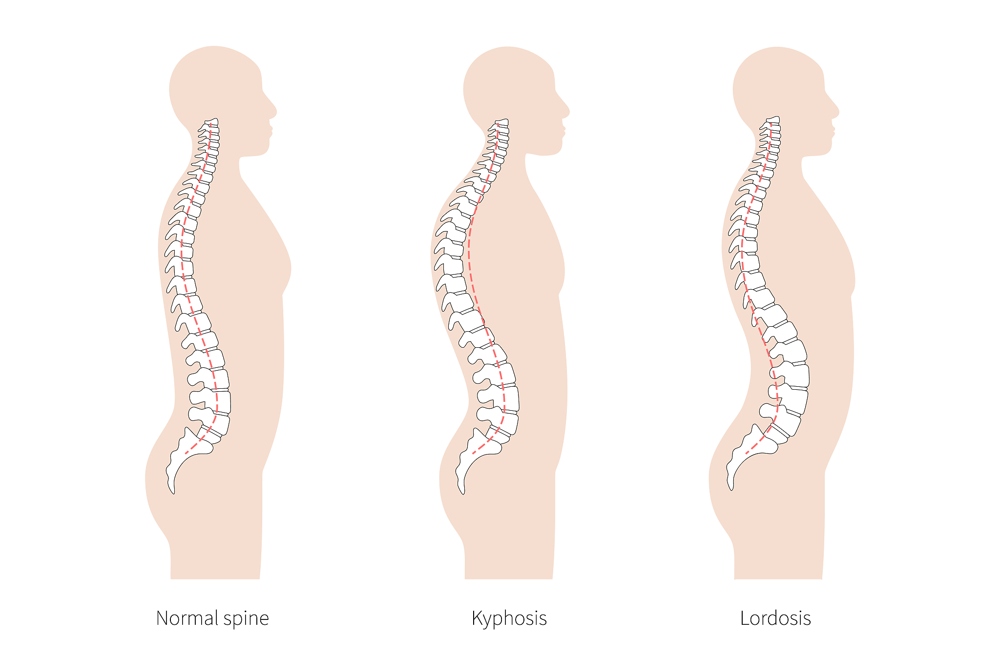 腰部两侧有凹陷的感觉