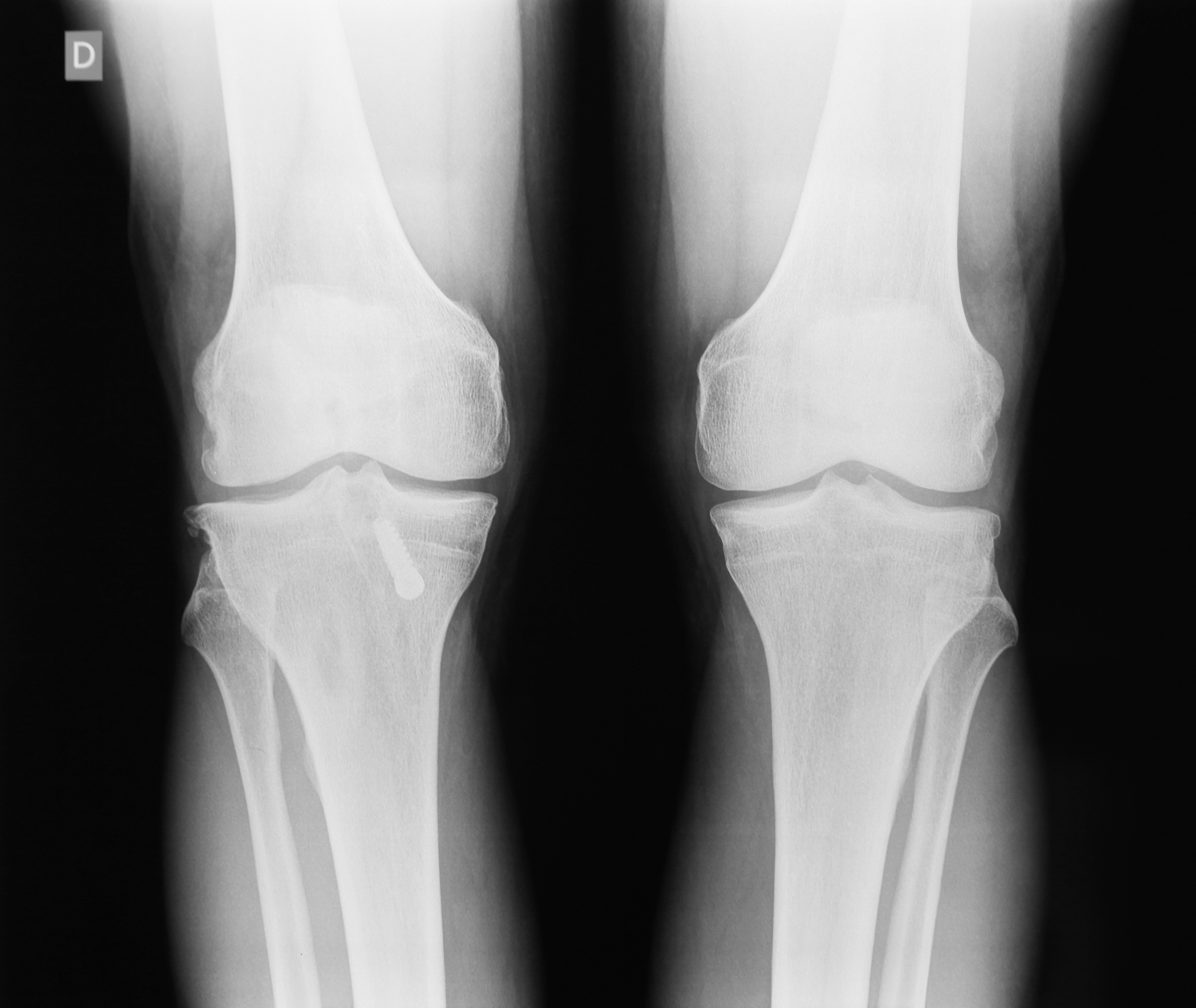 后外侧塌陷性胫骨平台骨折：治疗、康复及预后