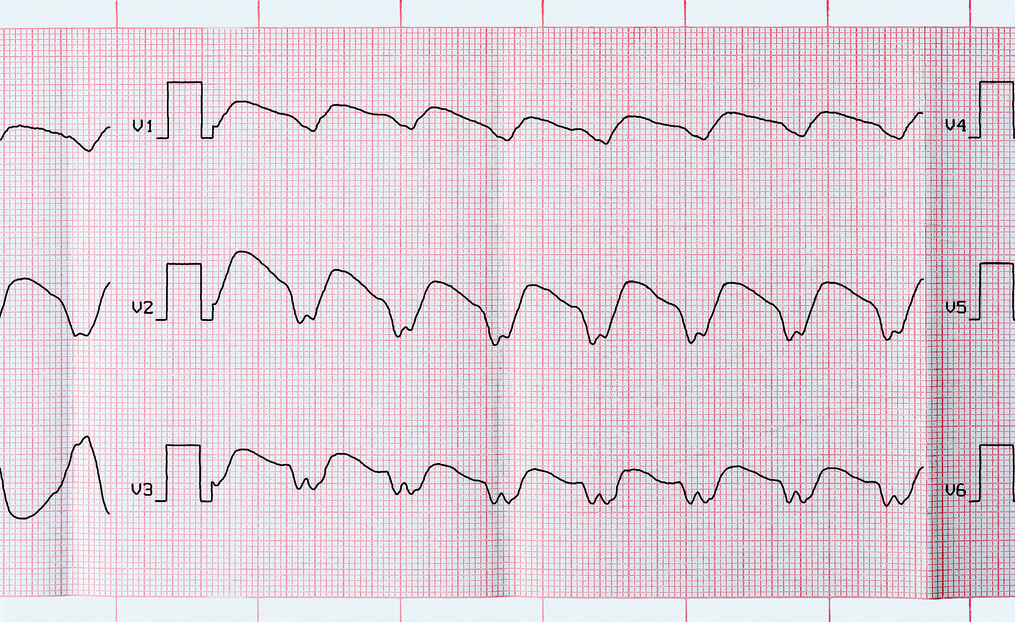 心室上心搏过速、心室心律失常和心搏过缓：心电数据均值方差对比分析