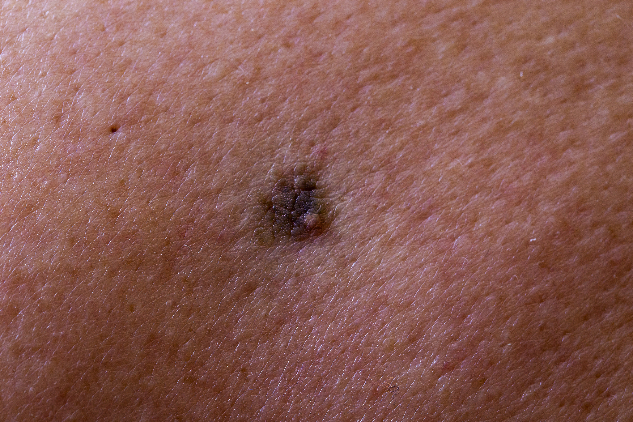 the initial stage of melanoma