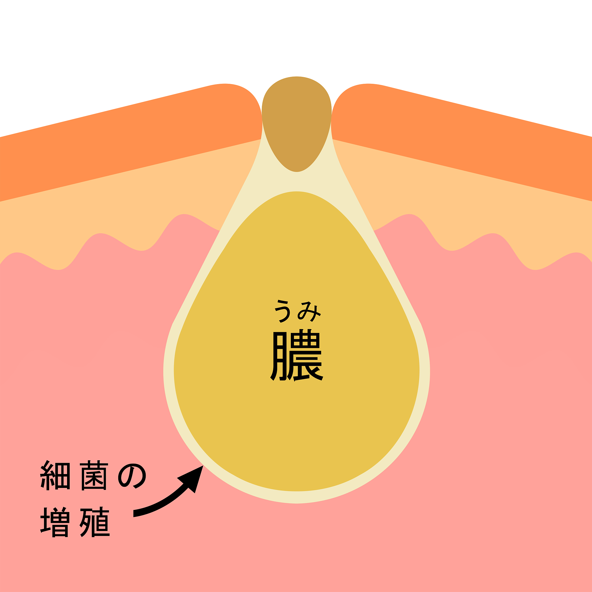脂肪粒痛有危险吗