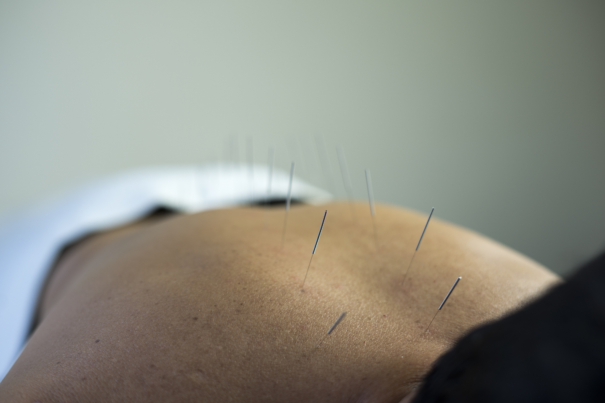 traditional acupuncture treatment