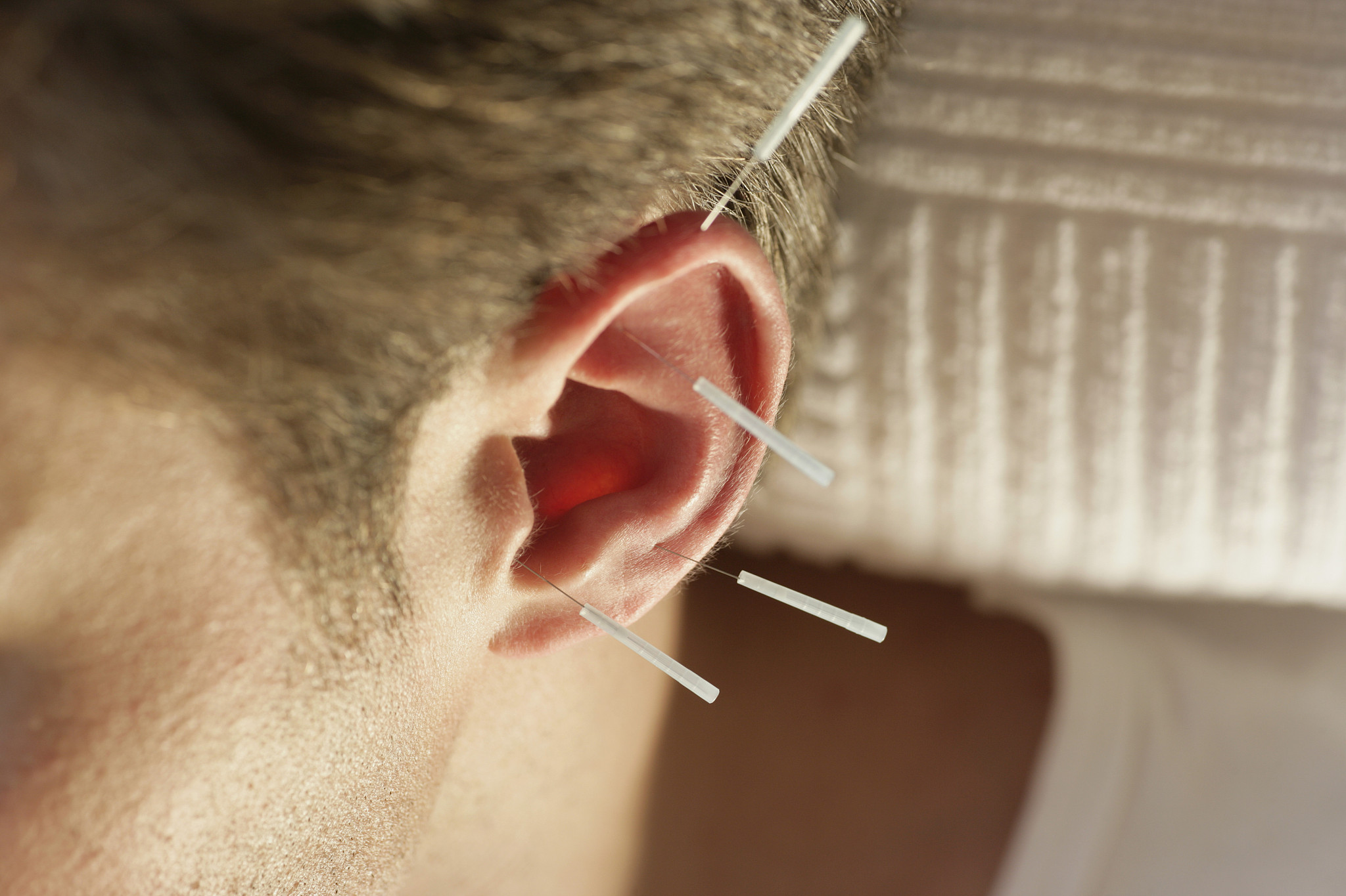 close-up of man with acupuncture needles on ear