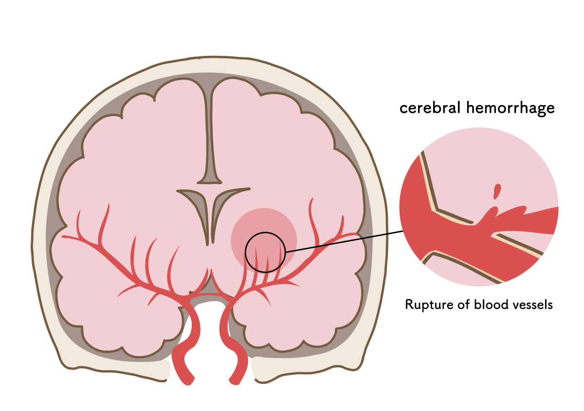 Dizziness, Weakness, and Unconsciousness: Identifying Cerebral Bridge Hemorrhage