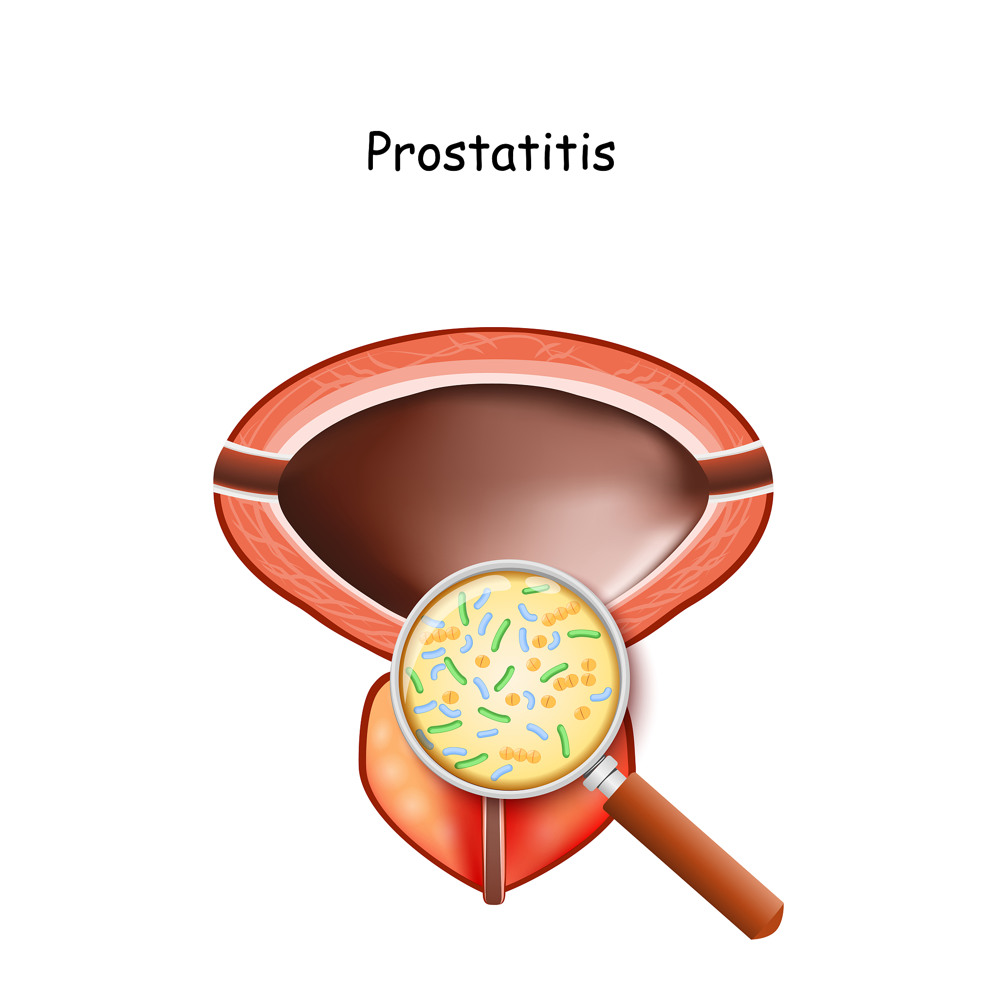 更改另外一种表达方式：良性前列腺增生Benigh prostate hyperplasiaBPH是引起男性排尿障碍最常见的泌尿外科疾病且随着年龄的增加 其患病率逐渐升高1。