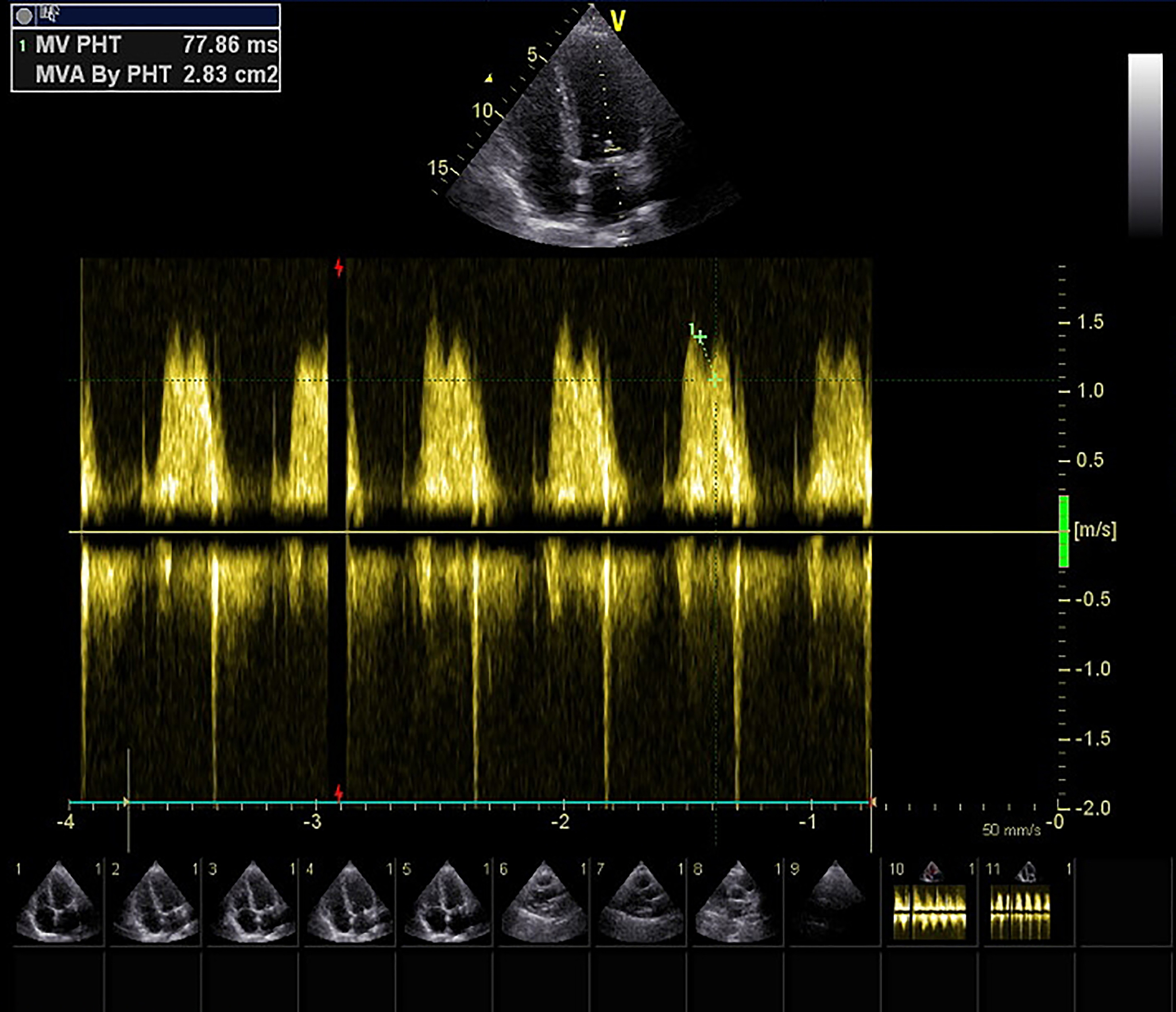 CVSD 编码失真：量阶自适应变化有效改善效果？