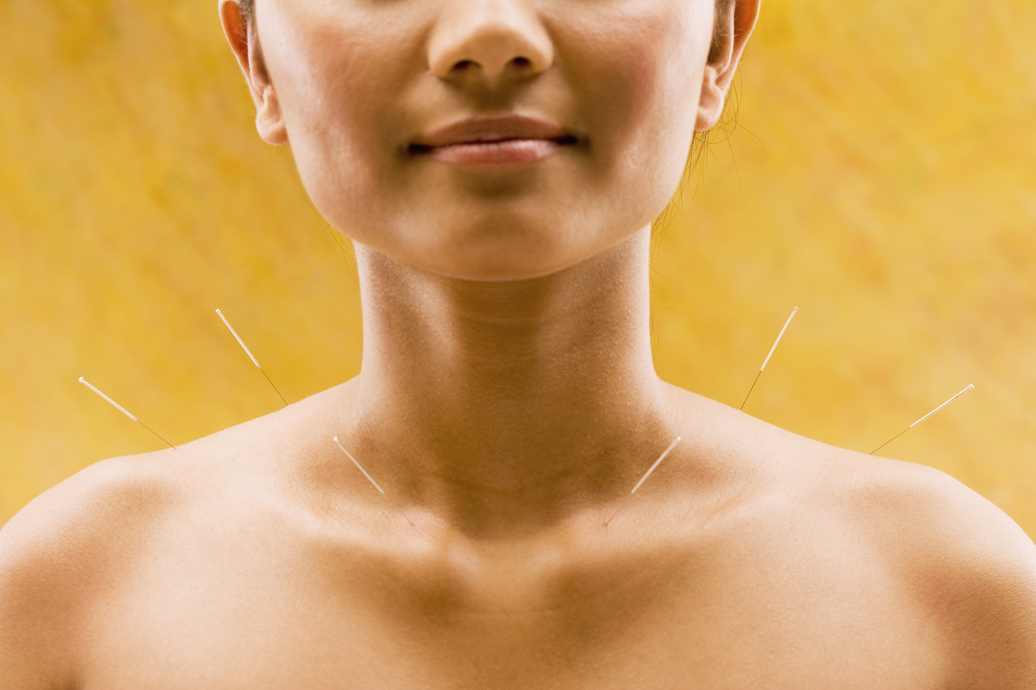 young woman getting acupuncture treatment