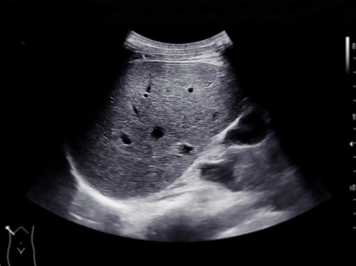 超声检查腋窝淋巴结时如何分区？