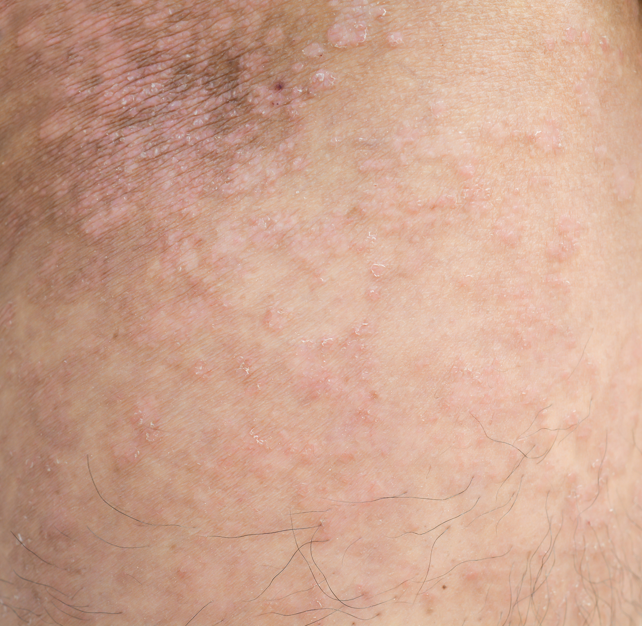 psoriasis on the skin