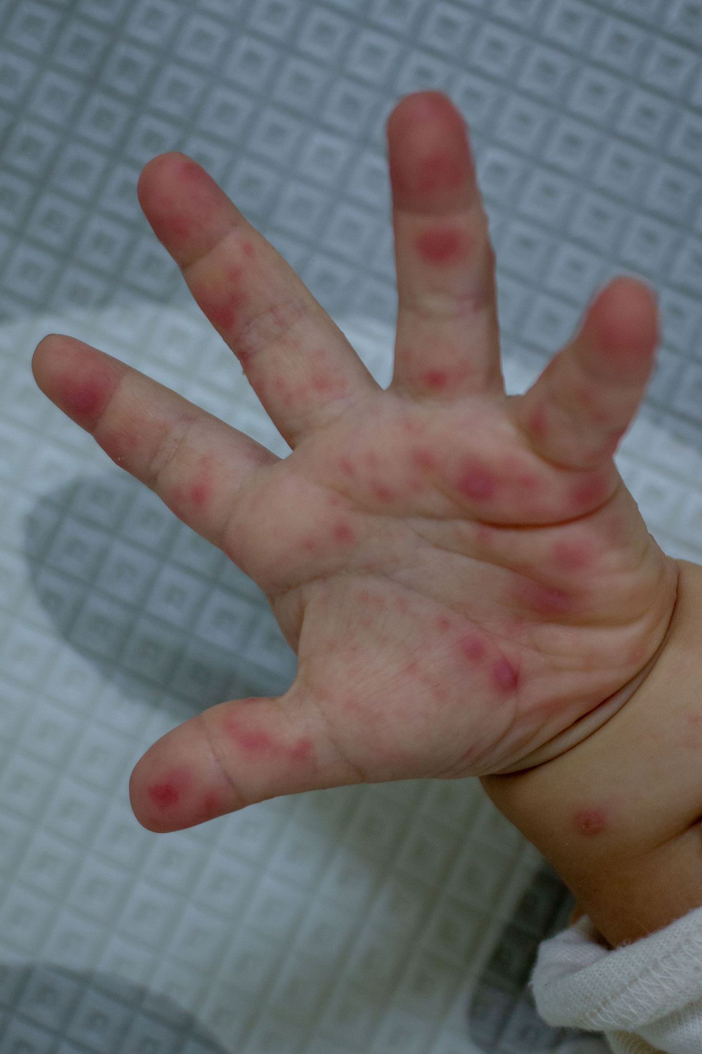 幼儿园手足口病预防工作总结及有效措施