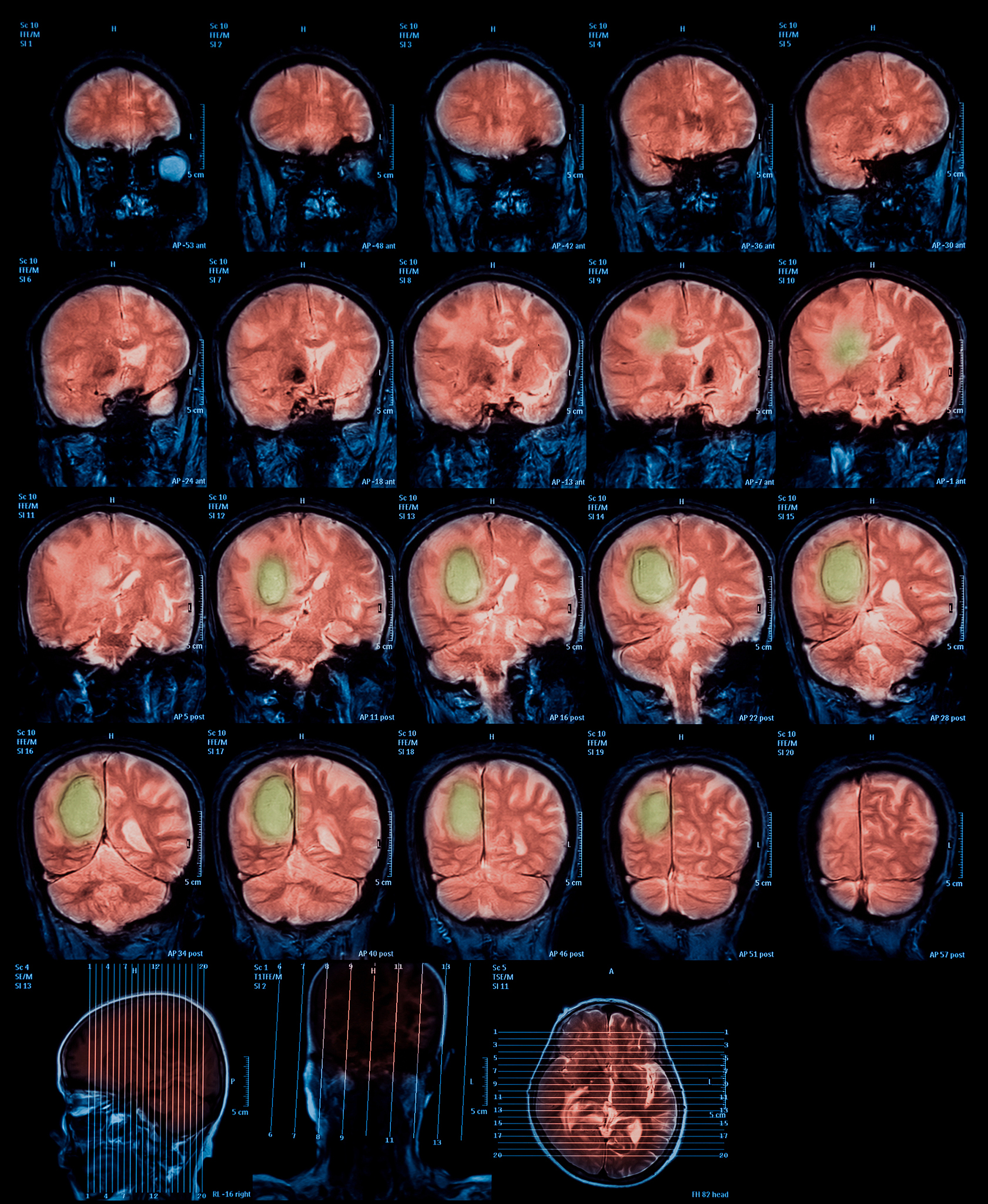 脑肿瘤：类型、症状、诊断和治疗 - 详细指南