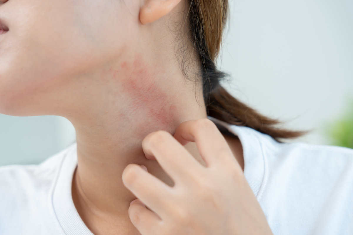 脸上长普通红癣怎么版