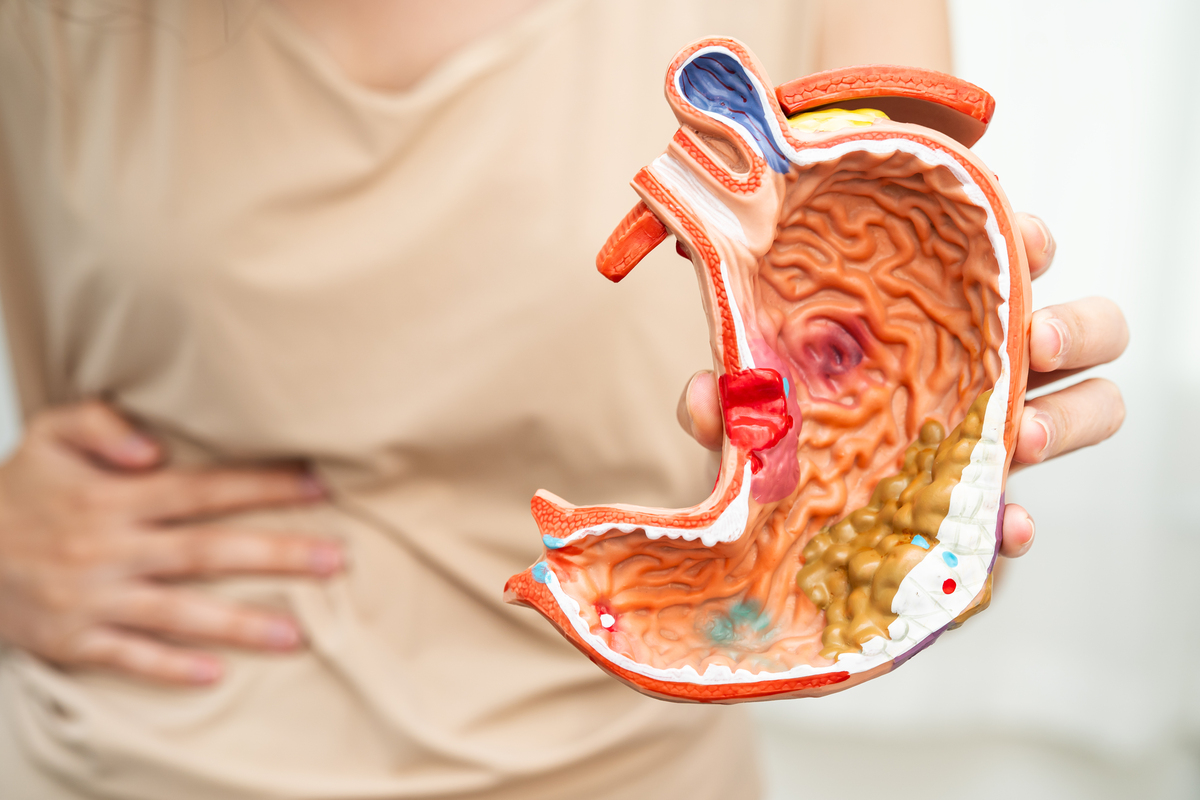 慢性胃炎：发病率、症状、病因和治疗