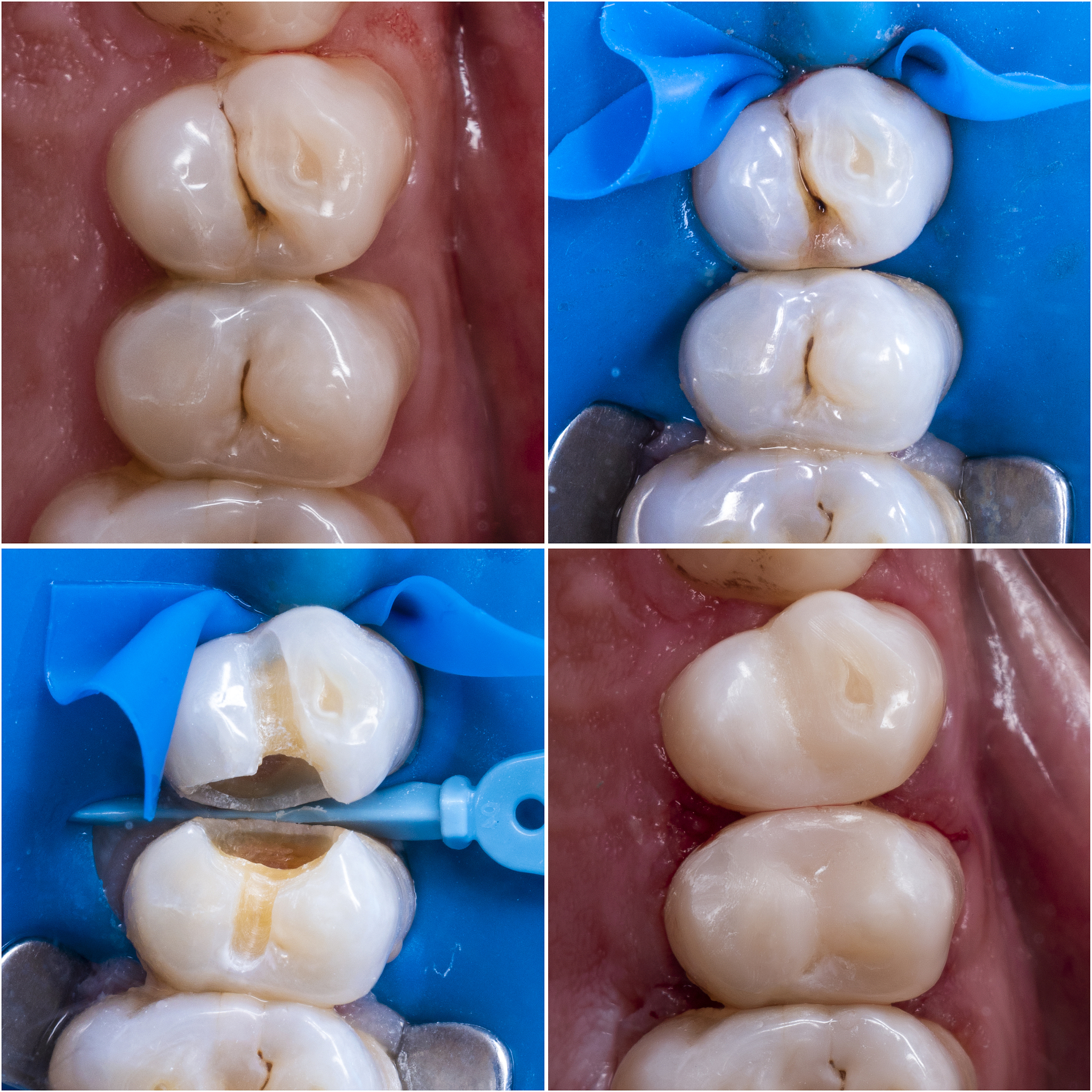 怀孕期间蛀牙可以去补牙吗？