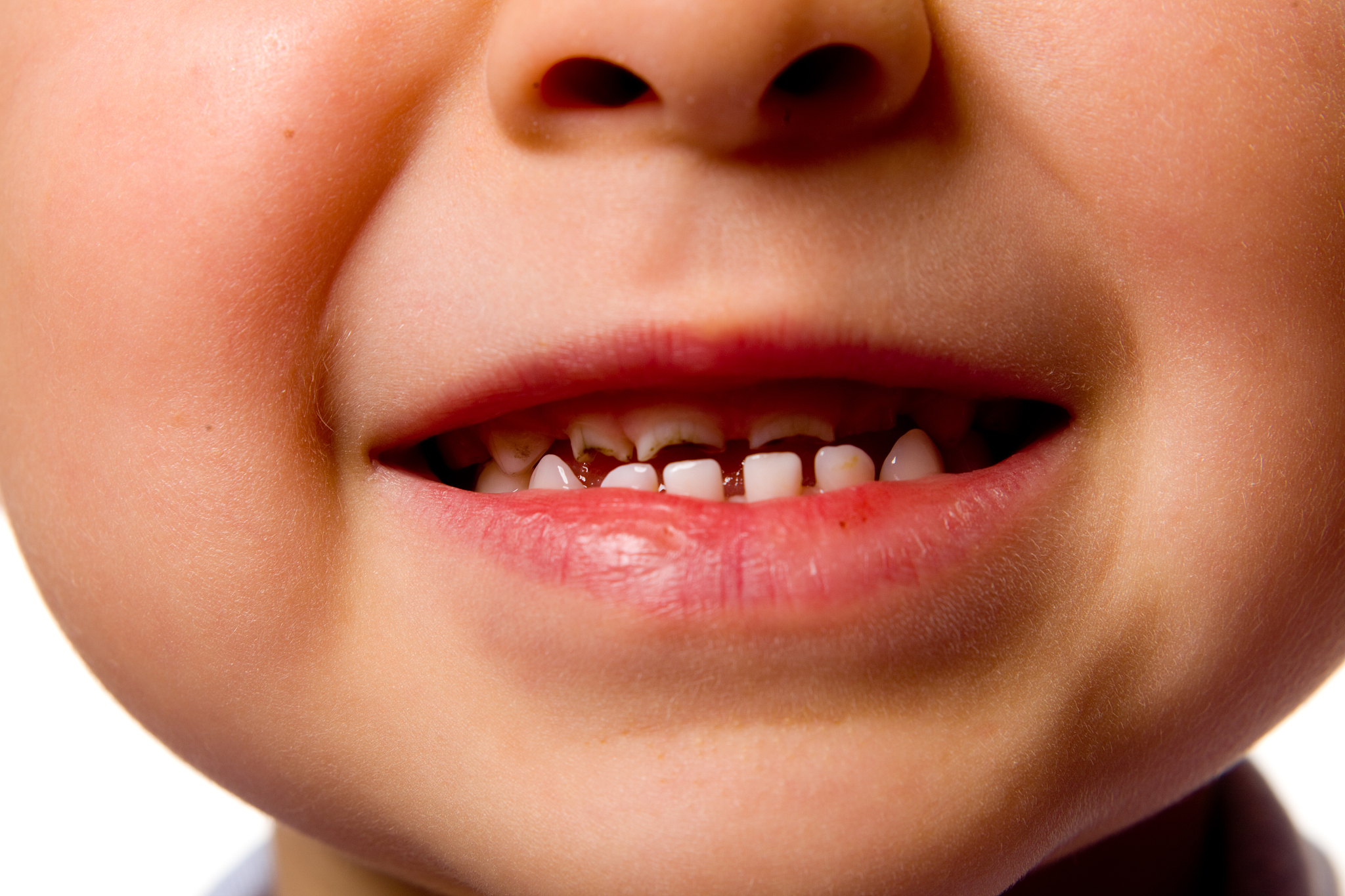 broken teeth in children 4 years