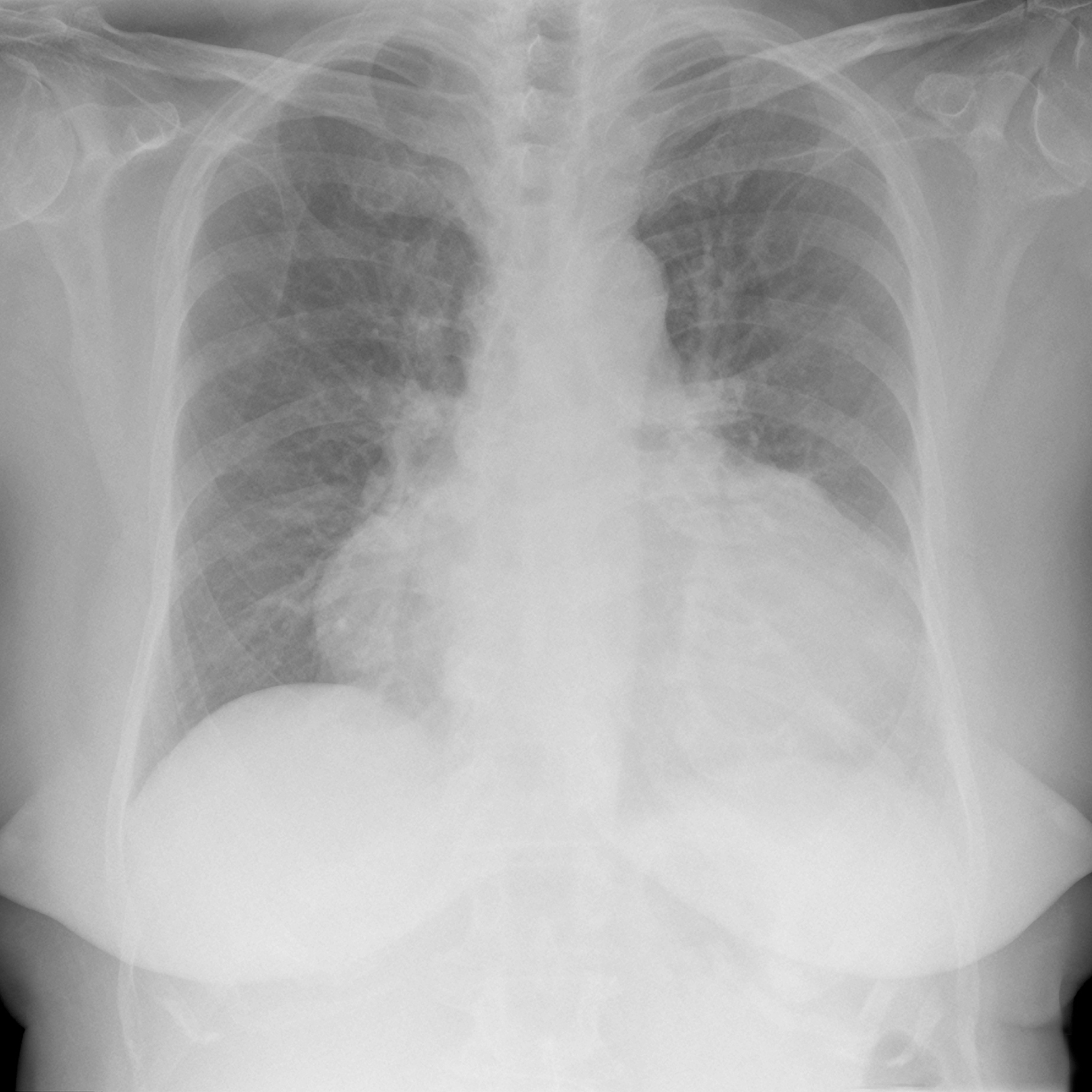 NT-proBNP水平超过1000pg/mL提示心衰风险