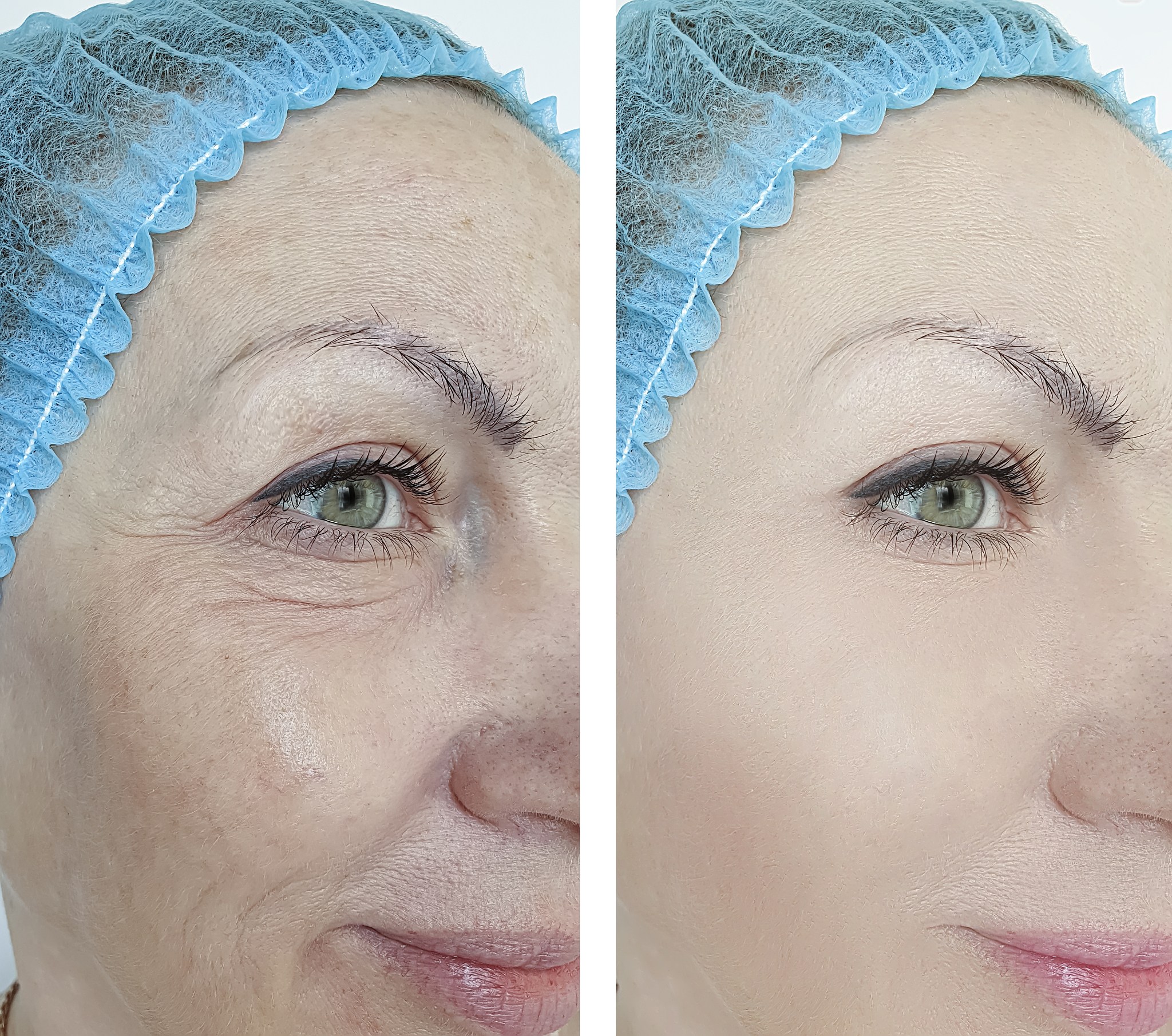 去除眼袋：有效方法及注意事项