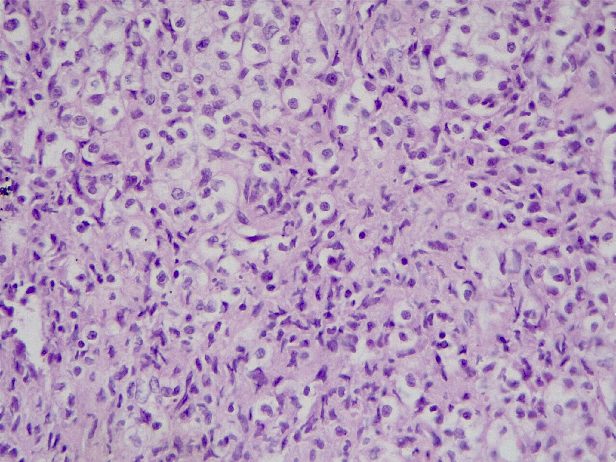 患者男19岁因右足拇指外伤合并化脓性感染细菌感染伴全身发热于2022年3月6日收入院。入院时患者神志清体温394oC。 	体检：右脚拇指伤口有脓液流出伤口周围红肿触痛明显右侧腹股沟可扪及多个肿大淋巴结蚕豆大小；淋巴结表面光滑无粘连可移动有压痛。左侧腹股沟未扪及肿大淋巴结。脾肋下未触及。请帮我分析一下这个病例