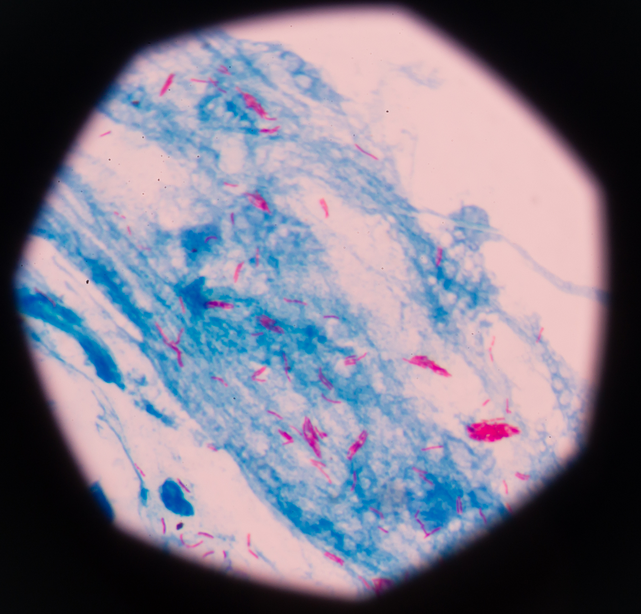 真菌性角膜炎中TSLP促进巨噬细胞向M1极化：机制与治疗潜力