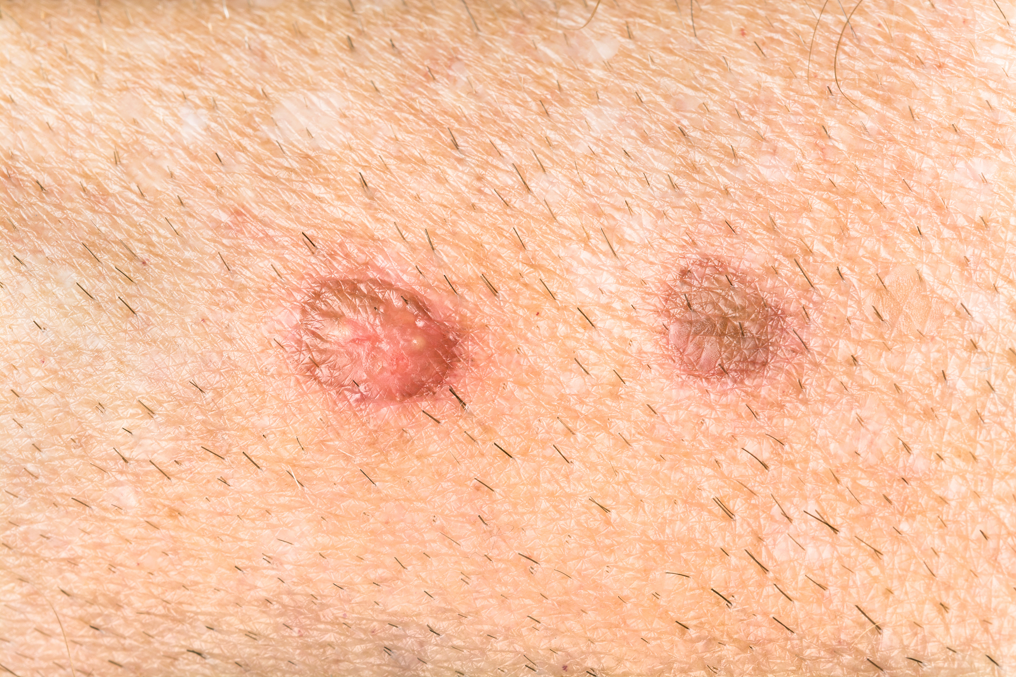 skin wounds