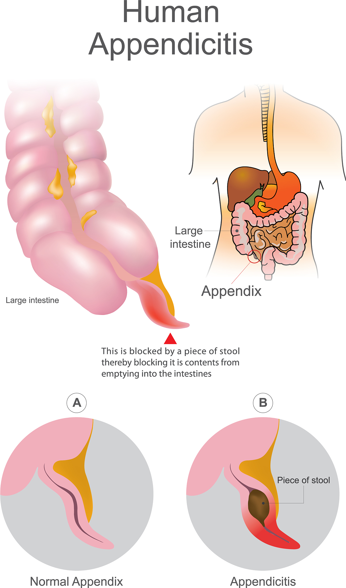 阑尾炎手术后恢复指南：饮食、休息、活动和并发症