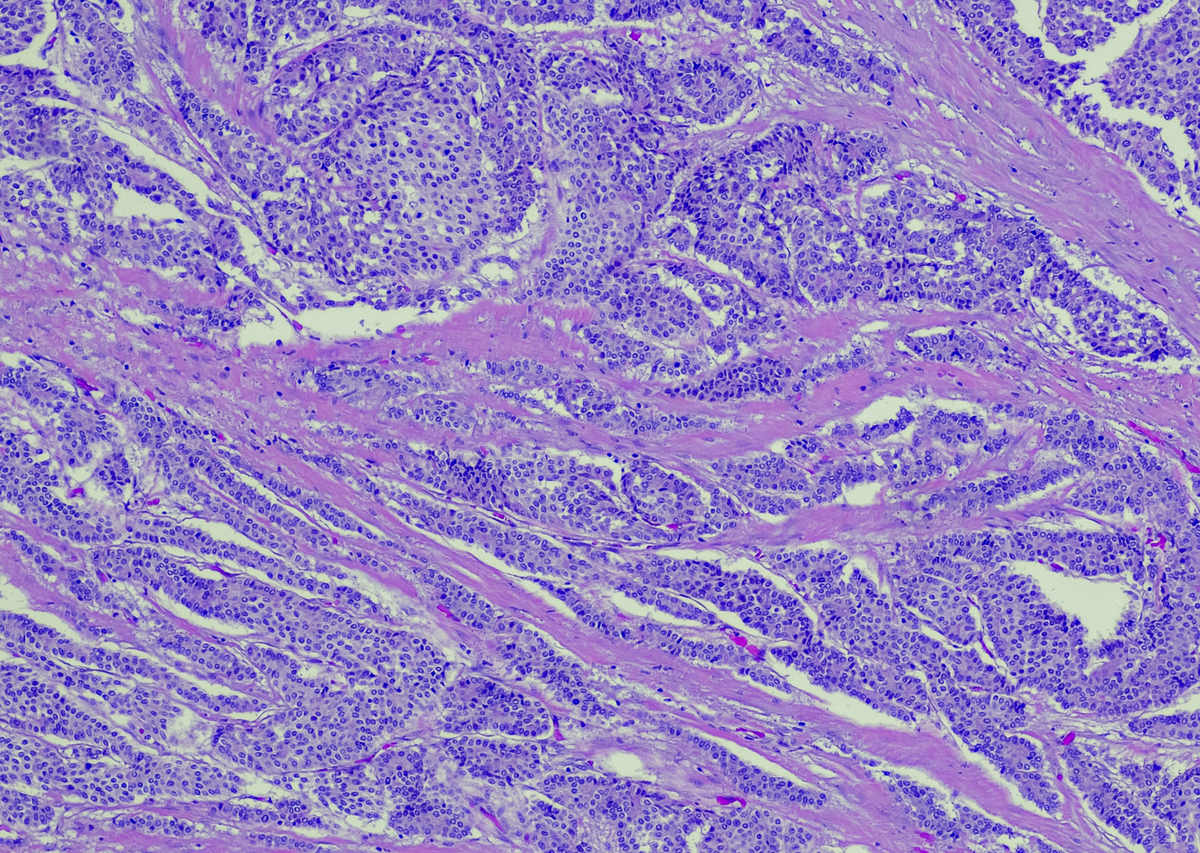 乳腺肿瘤分割：准确识别肿瘤区域，助力精准治疗