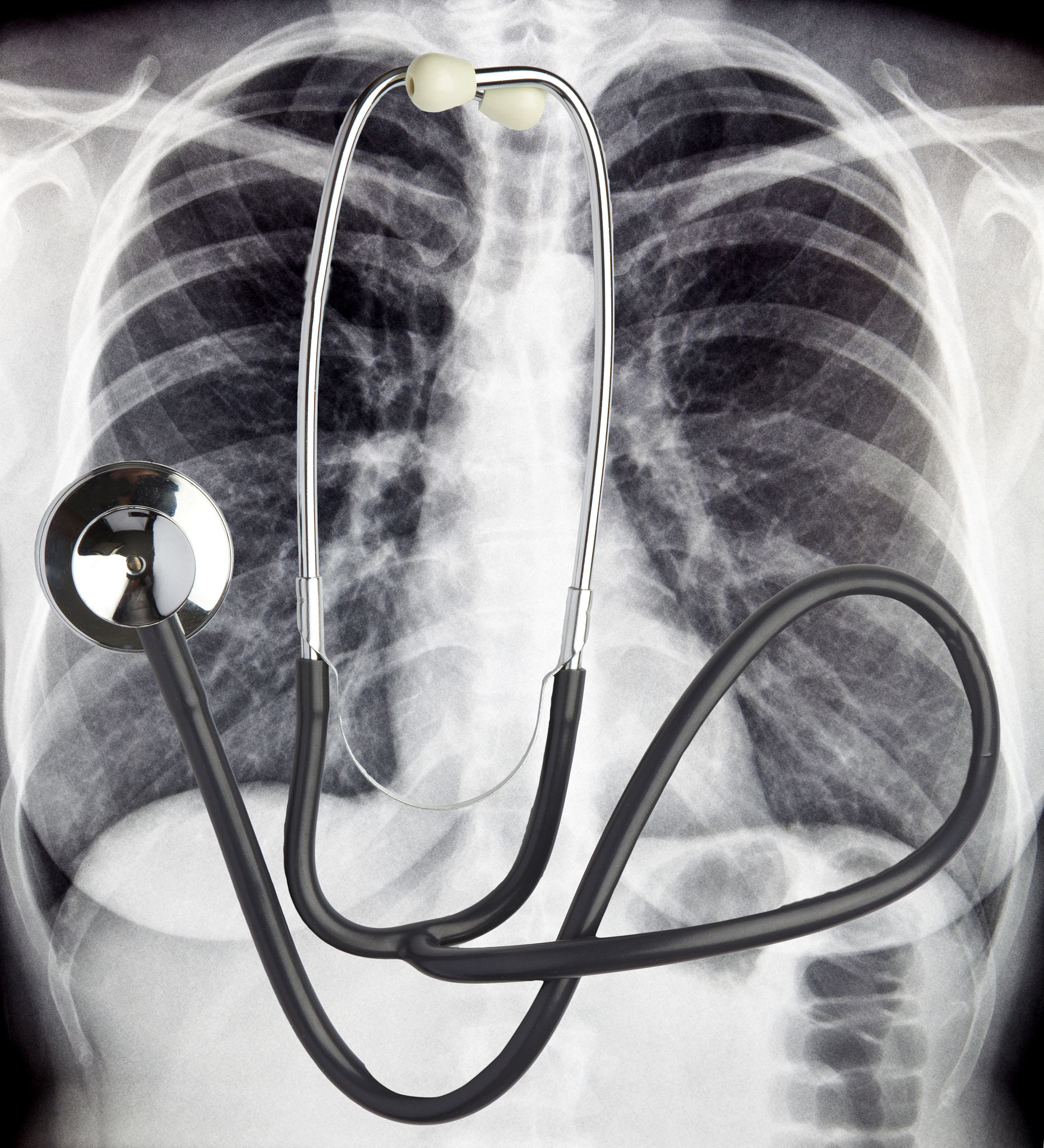 气管插管术语解释：喘振、管外颈缩、向上球型脱落、向上T型脱落