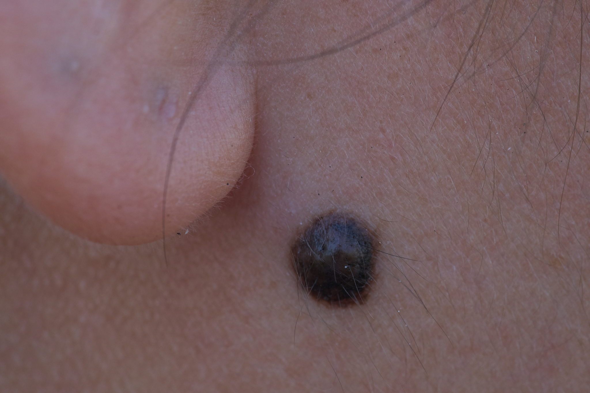 nevus or mole under the ears of asian women.
