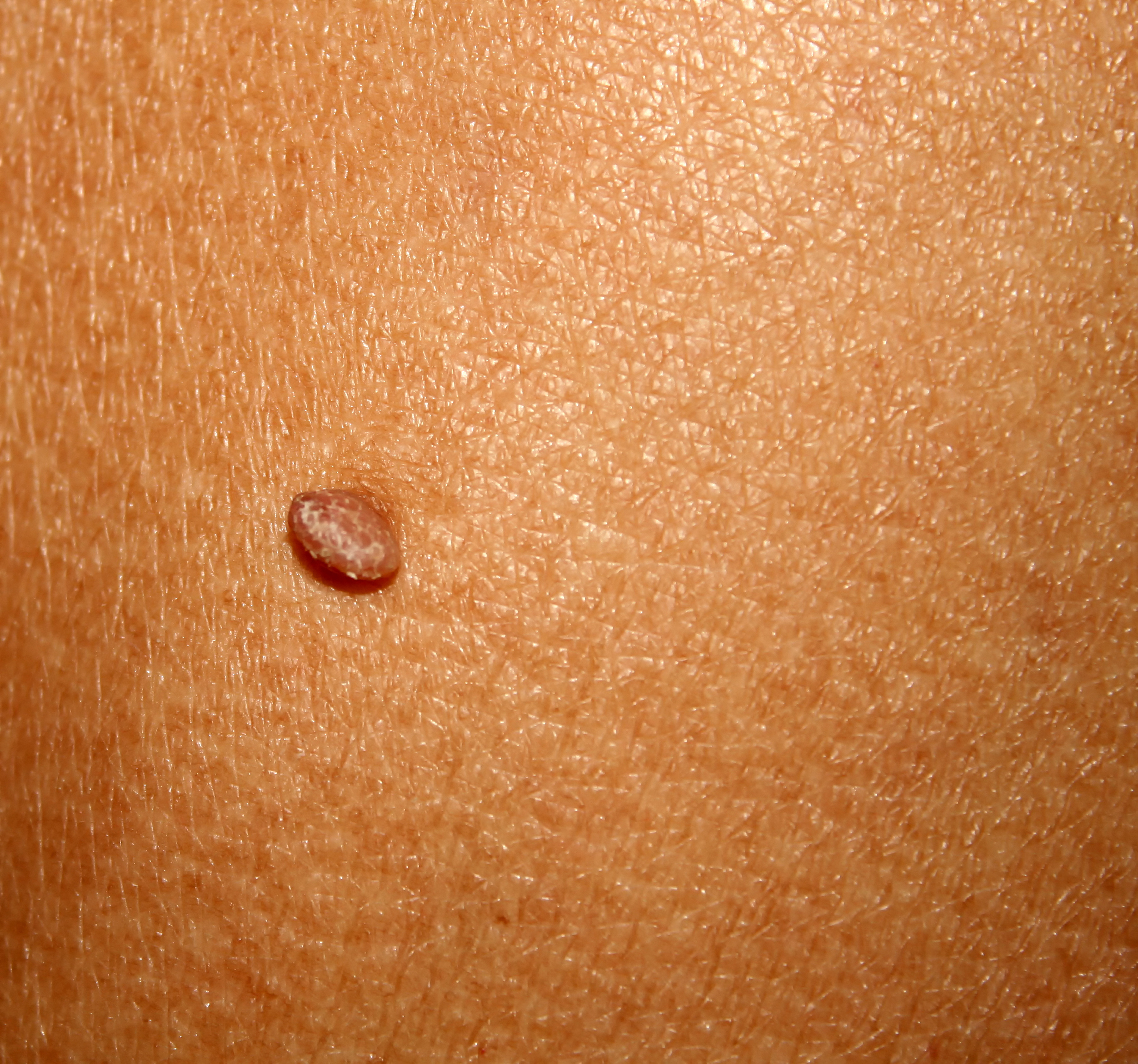 birthmark on the skin