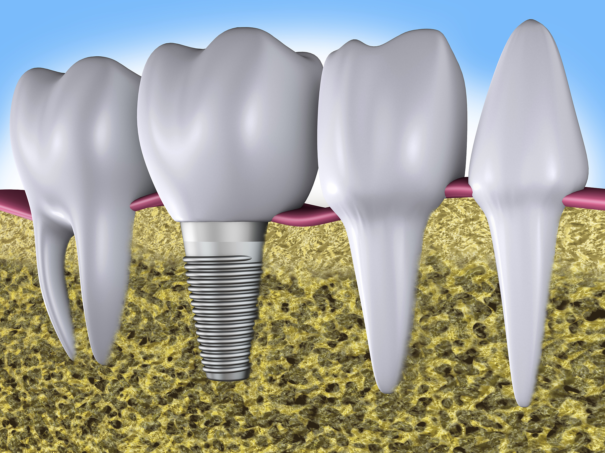 Peri-prosthetic Bone Loss: Understanding Implant Wear and Delamination