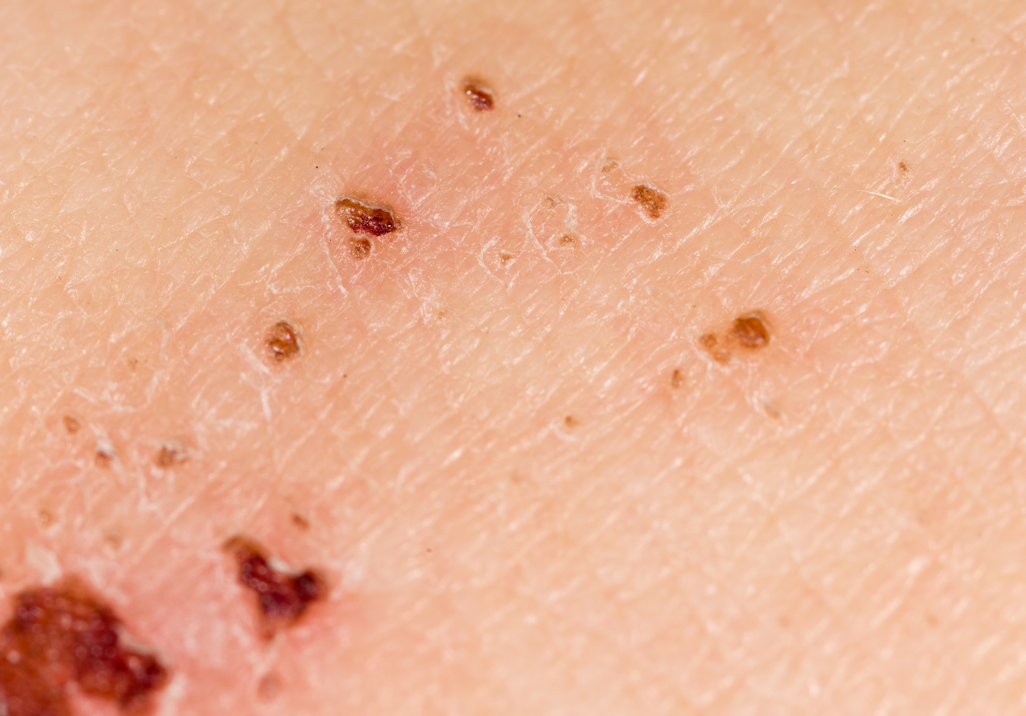 wound on the skin of a person