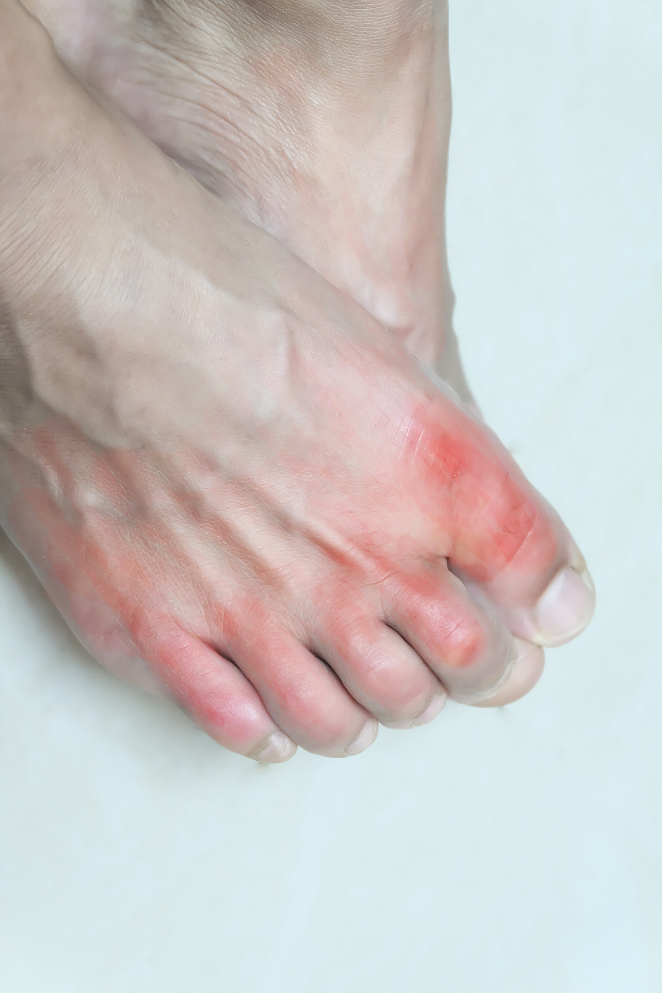 痛风如何消肿止痛