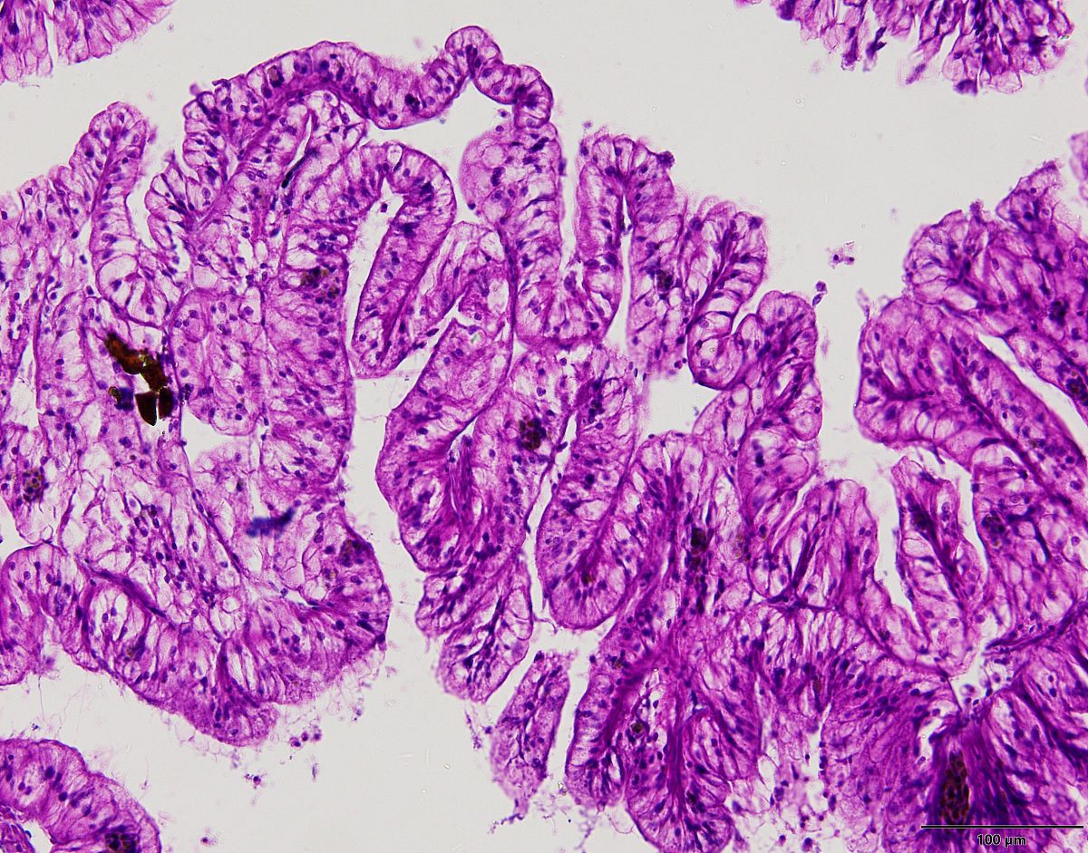 乳腺癌骨转移模型：尾静脉注射成功率及影响因素