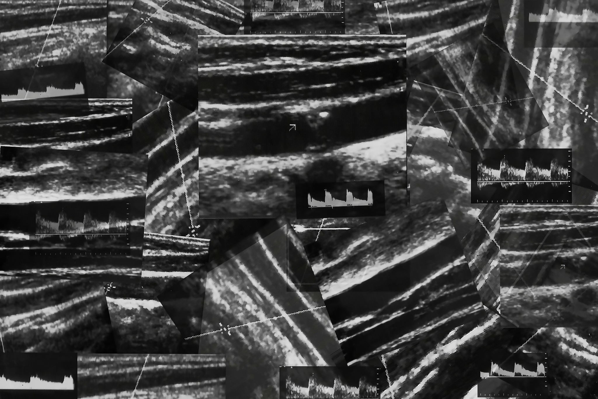 颈动脉易损斑块早期诊断：降低中风风险的关键