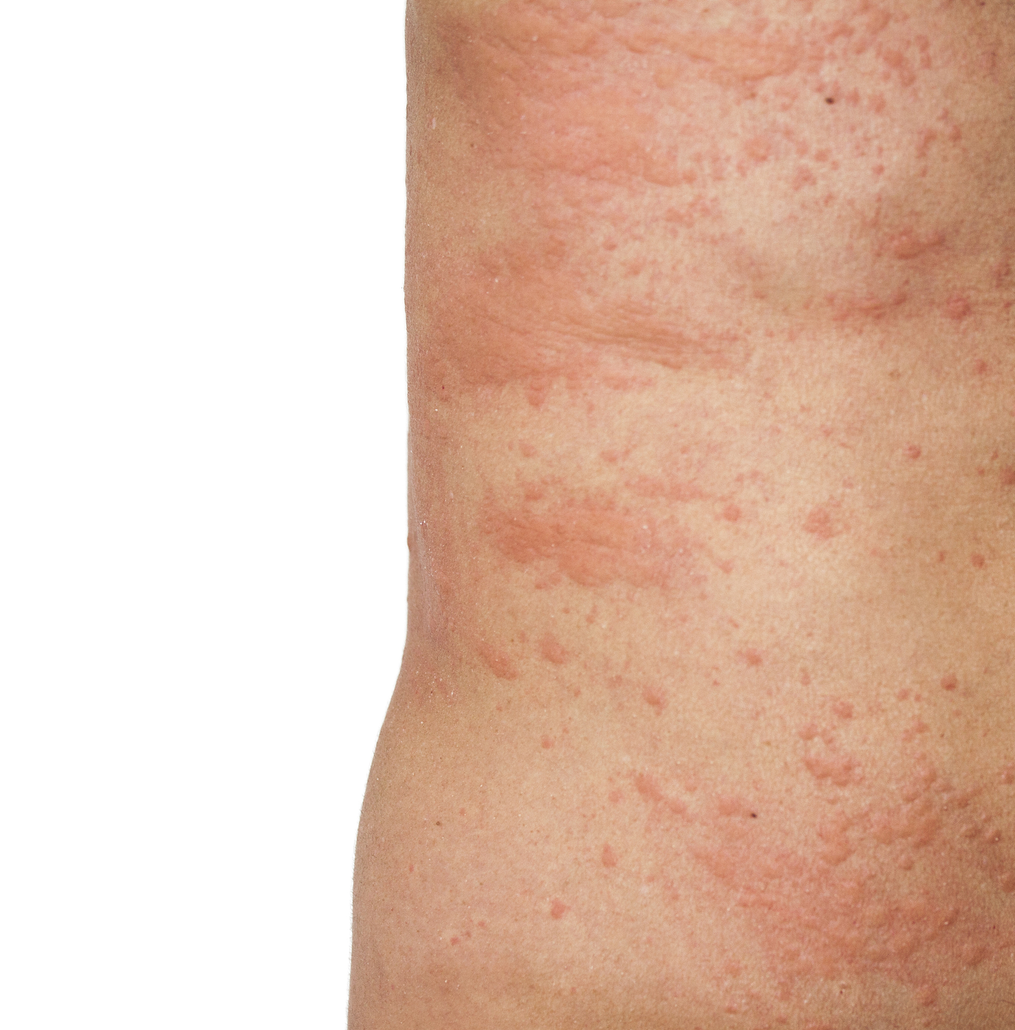 毛囊炎是艾滋病的早期症状吗