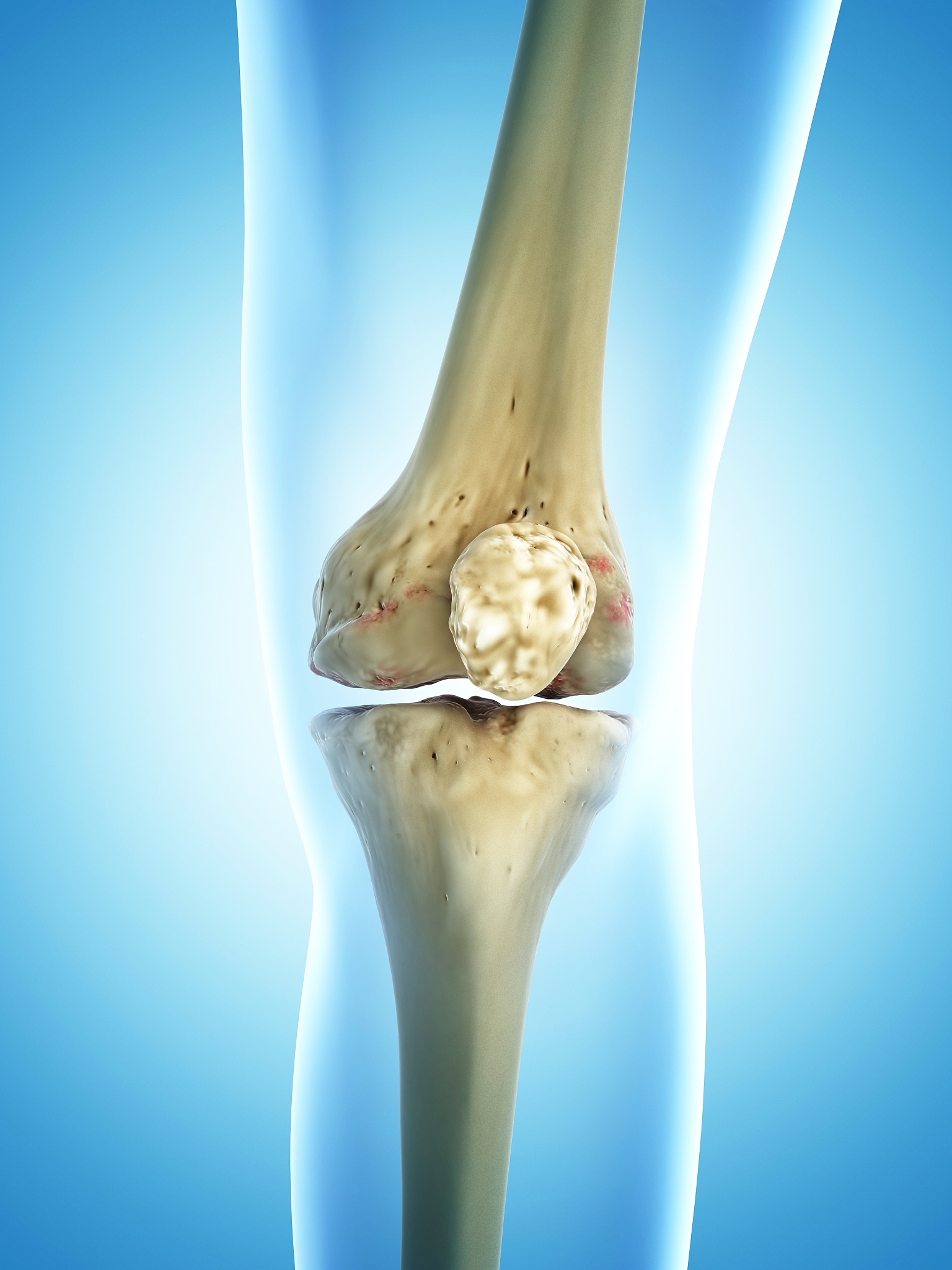 膝关节骨性关节炎：症状、治疗与预防